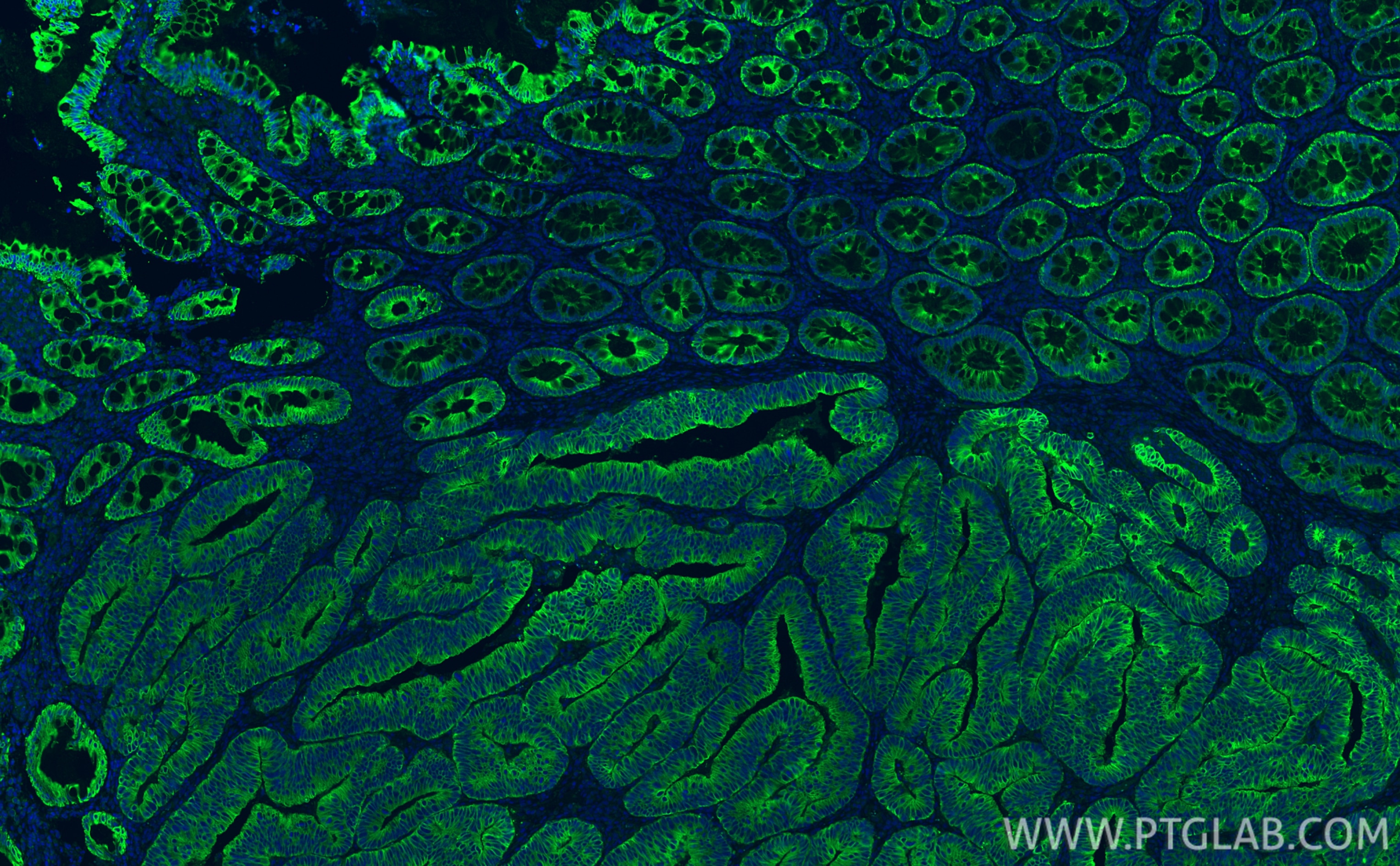 Immunofluorescence (IF) / fluorescent staining of human colon cancer tissue using Pan-Keratin (TypeⅡ) Recombinant antibody (86370-1-RR)