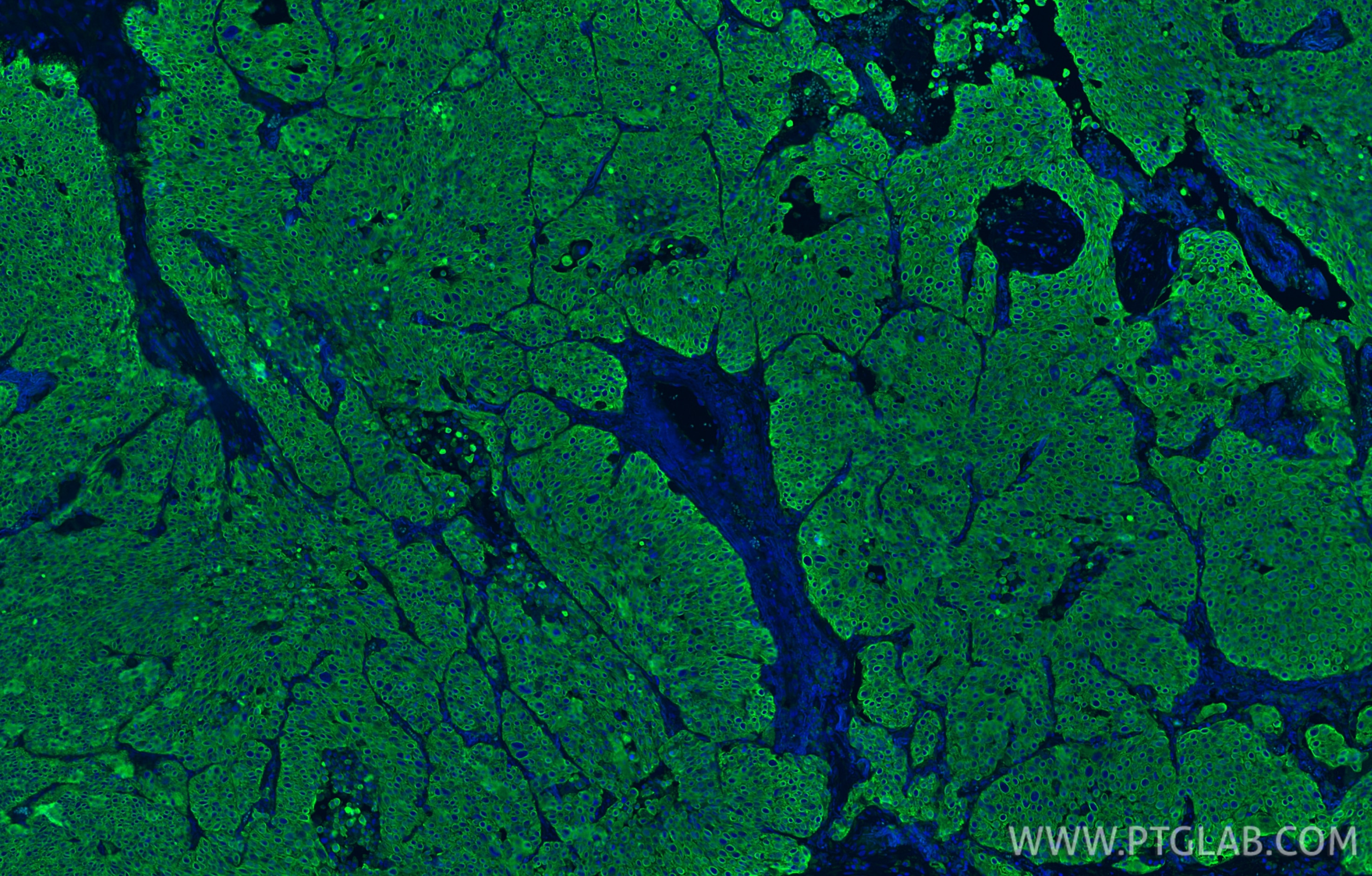 Immunofluorescence (IF) / fluorescent staining of human lung cancer tissue using Pan-Keratin (TypeⅡ) Recombinant antibody (86370-1-RR)