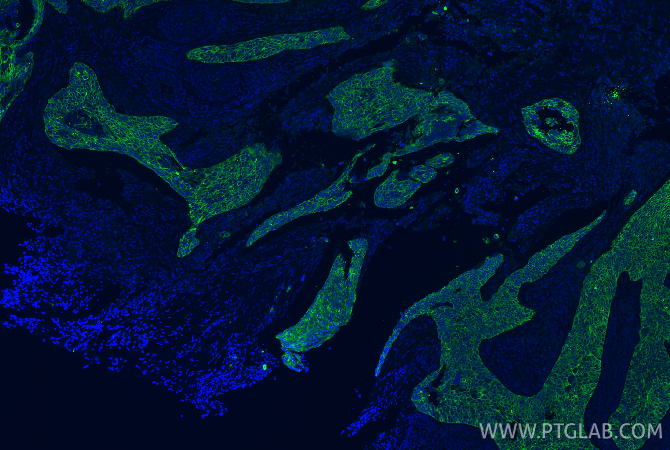 Immunofluorescence (IF) / fluorescent staining of human cervical cancer tissue using Pan-Keratin (TypeⅡ) Recombinant antibody (86370-1-RR)