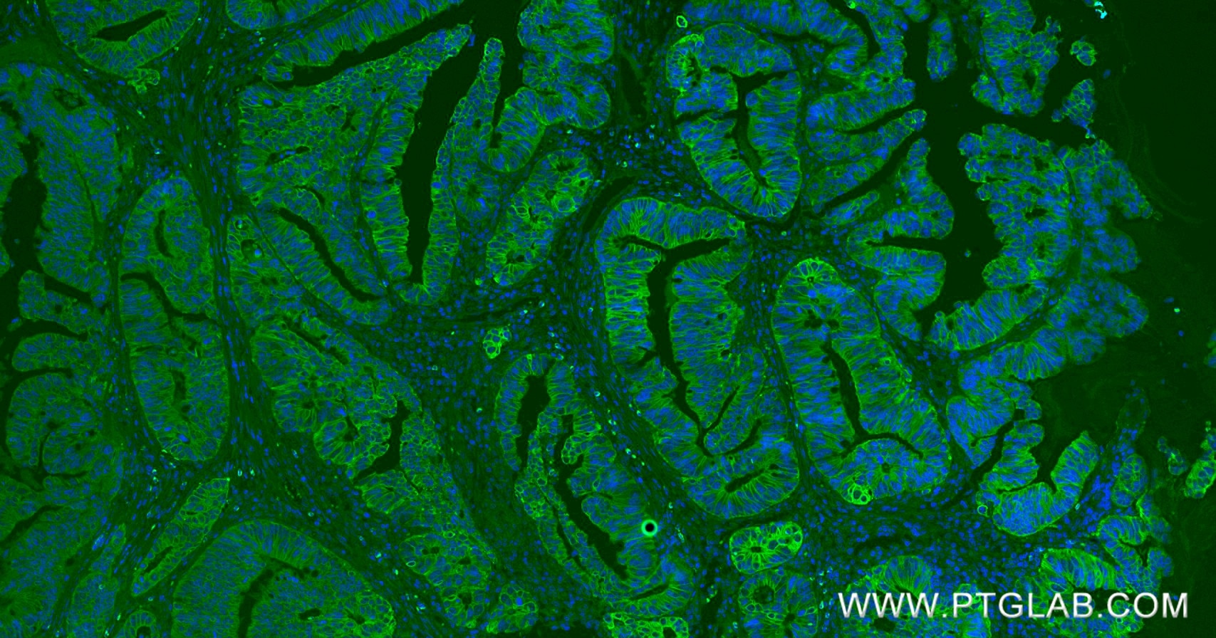 Immunofluorescent analysis of (4% PFA) fixed paraffin-embedded human colon cancer tissue using Pan-Keratin (TypeⅡ) antibody (86370-1-RR, Clone: 251040F7 ) at dilution of 1:500 and CoraLite®488-Conjugated Goat Anti-Rabbit IgG(H+L) (SA00013-2). Heat mediated antigen retrieval with Tris-EDTA buffer (pH 9.0). Immunofluorescence (IF) / fluorescent staining of human colon cancer tissue using Pan-Keratin (TypeⅡ) Recombinant monoclonal antibod (86370-1-RR)