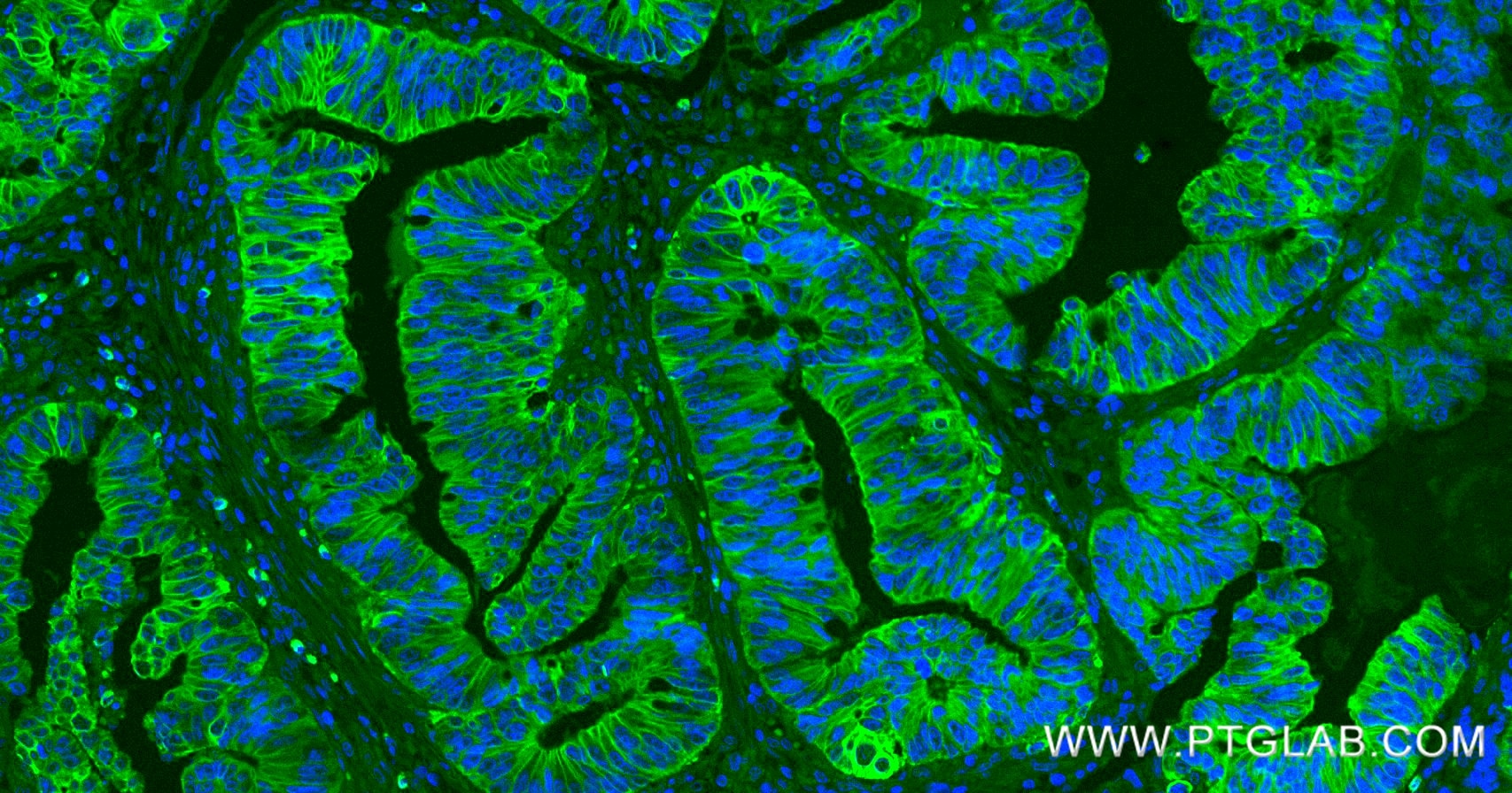 Immunofluorescent analysis of (4% PFA) fixed paraffin-embedded human colon cancer tissue using Pan-Keratin (TypeⅡ) antibody (86370-1-RR, Clone: 251040F7 ) at dilution of 1:500 and CoraLite®488-Conjugated Goat Anti-Rabbit IgG(H+L) (SA00013-2). Heat mediated antigen retrieval with Tris-EDTA buffer (pH 9.0). Immunofluorescence (IF) / fluorescent staining of human colon cancer tissue using Pan-Keratin (TypeⅡ) Recombinant monoclonal antibod (86370-1-RR)