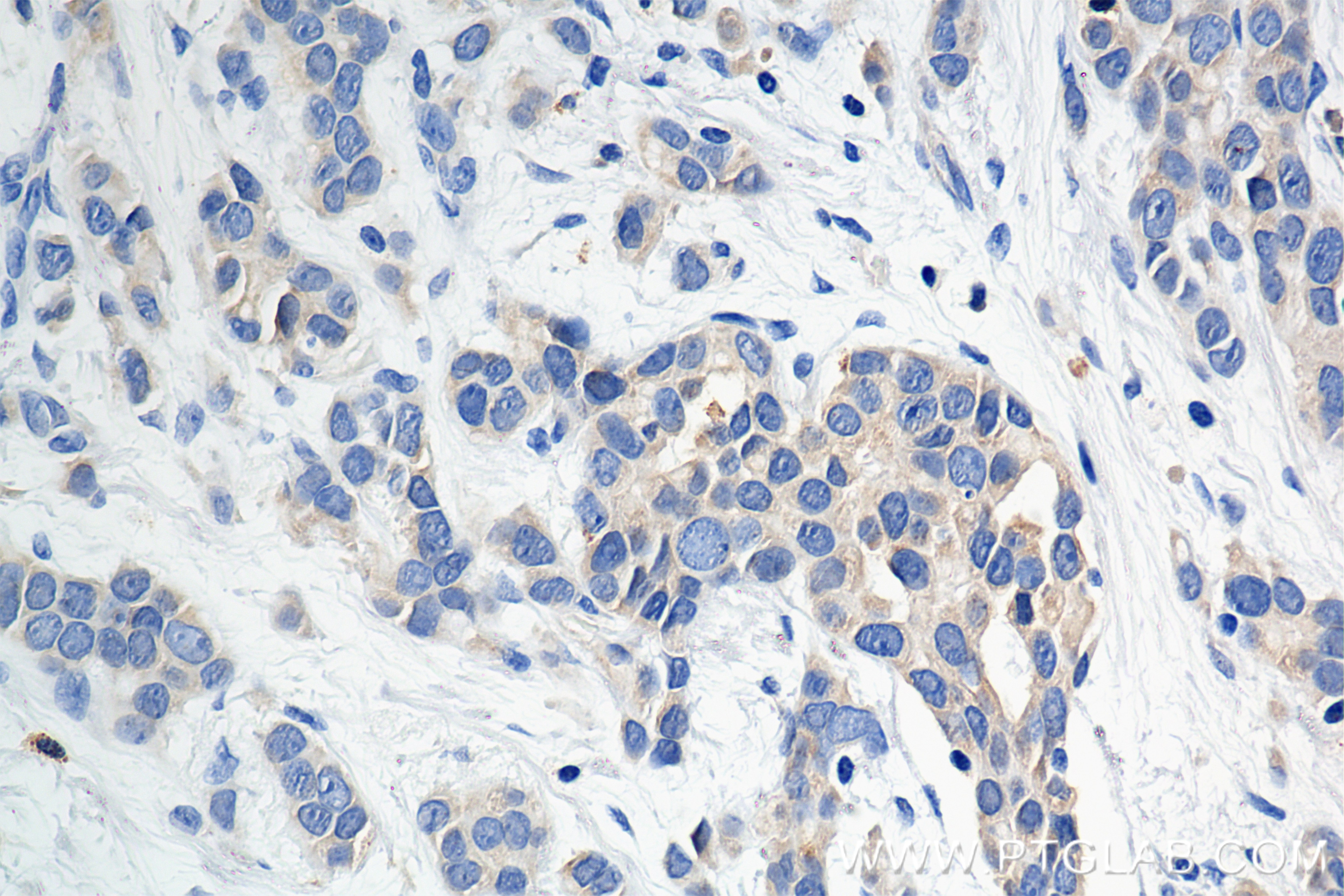 Immunohistochemistry (IHC) staining of human breast cancer tissue using Pan-Keratin (TypeⅡ) Recombinant antibody (86370-1-RR)