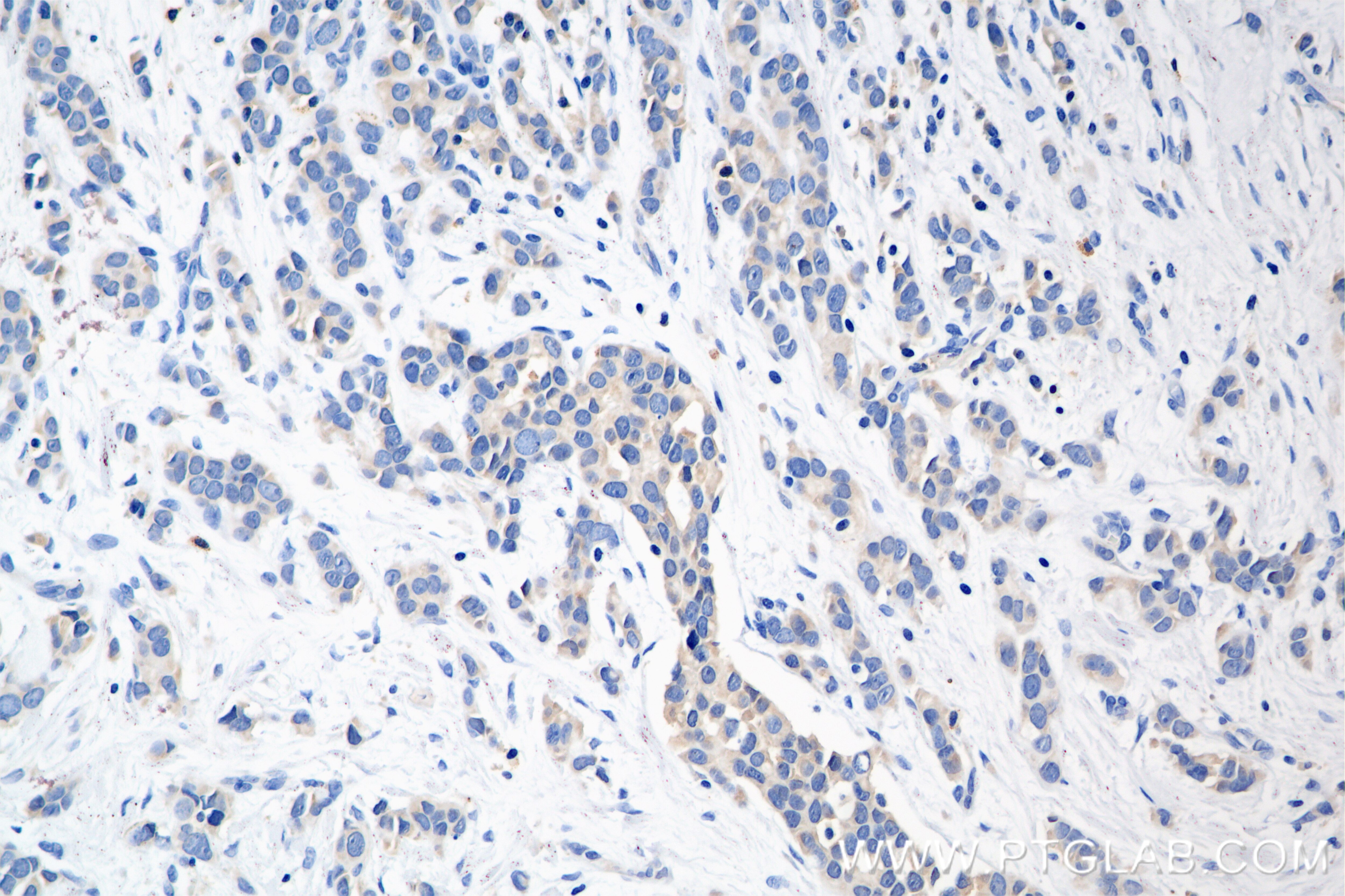 Immunohistochemistry (IHC) staining of human breast cancer tissue using Pan-Keratin (TypeⅡ) Recombinant antibody (86370-1-RR)