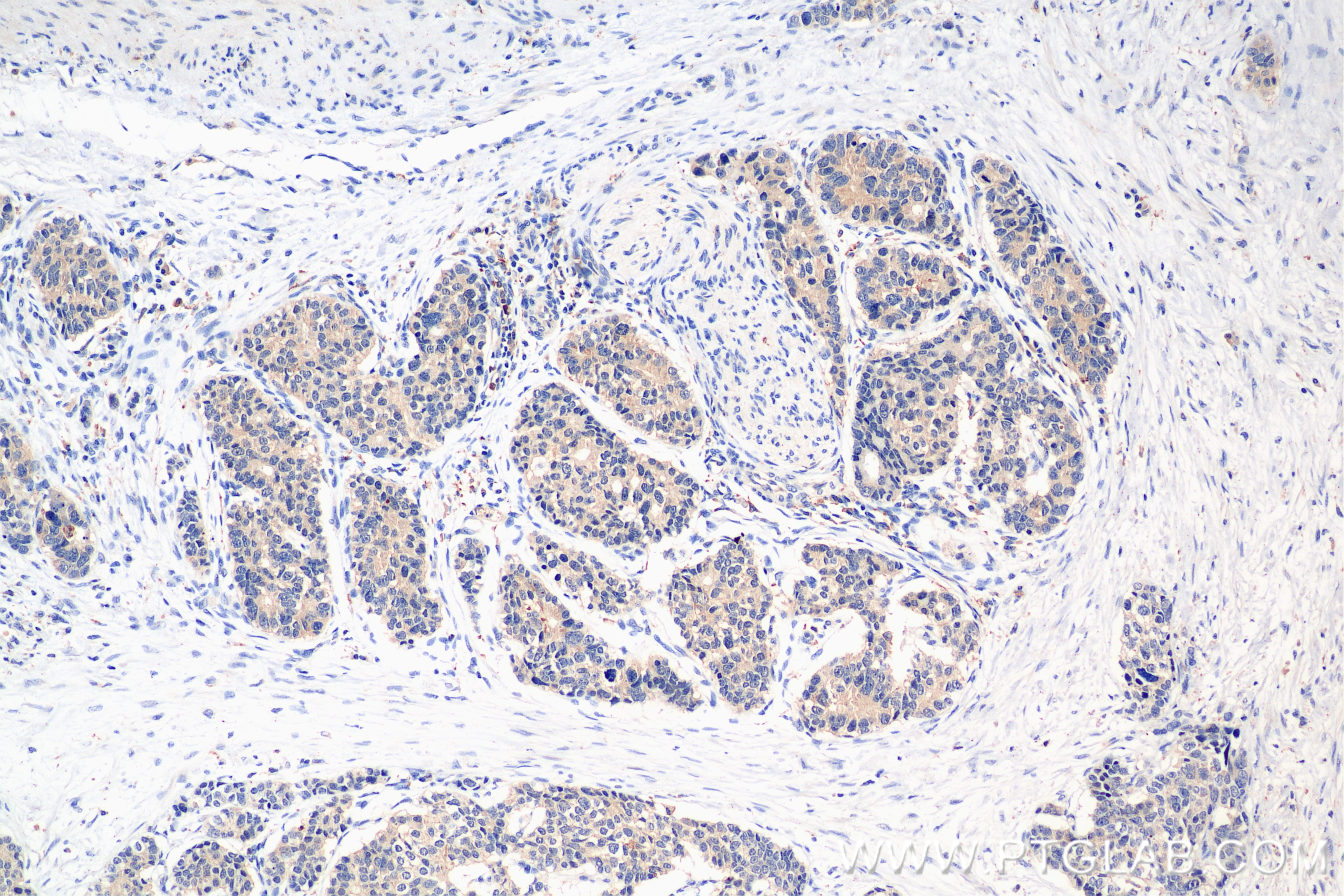 Immunohistochemistry (IHC) staining of human stomach cancer tissue using Pan-Keratin (TypeⅡ) Recombinant antibody (86370-1-RR)
