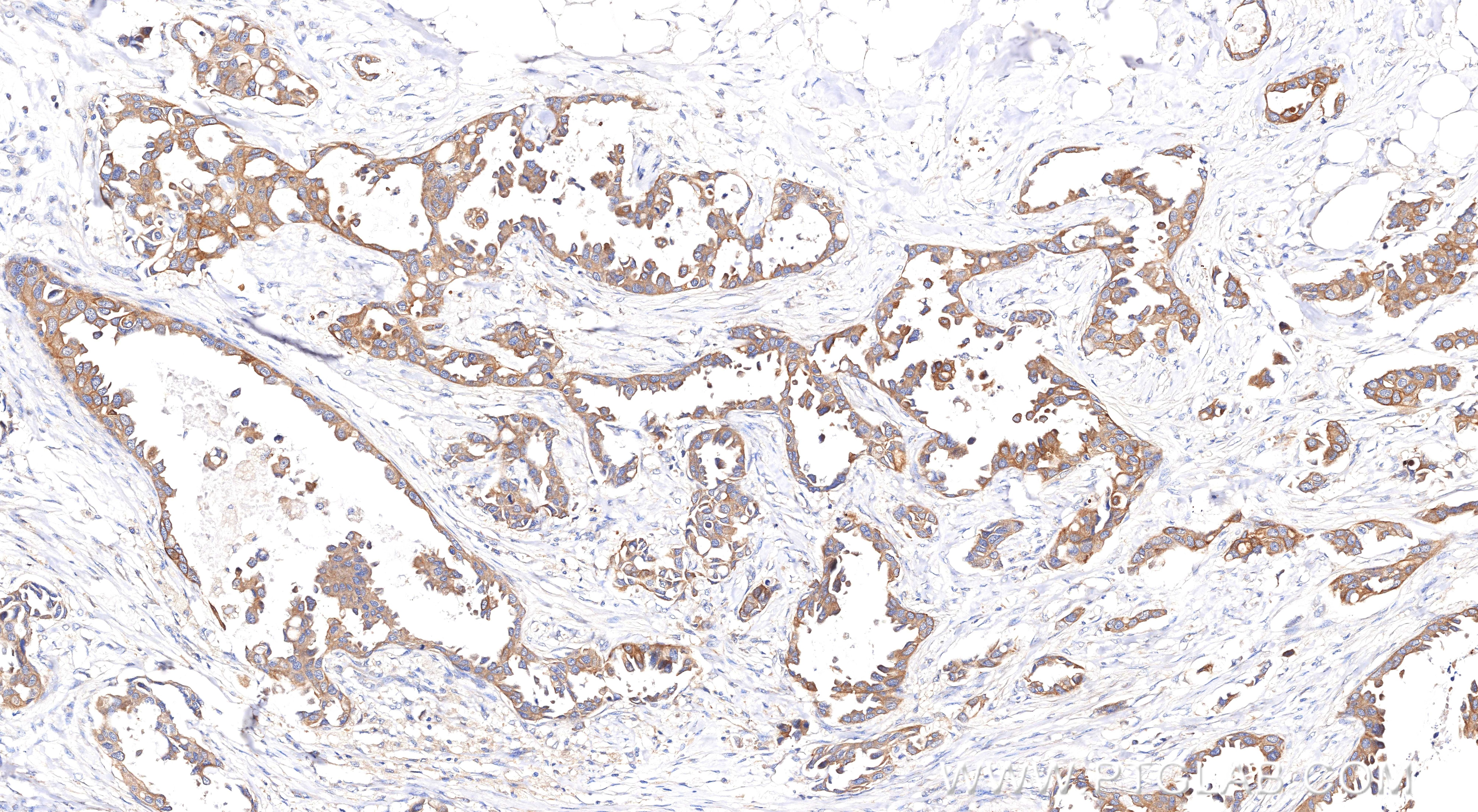 Immunohistochemical analysis of paraffin-embedded Human Breast Cancer(Her2+;ER-;PR-) slide using 86370-1-RR (Pan-Keratin (TypeⅡ) antibody) at dilution of 1:1000 (under 10x lens). Heat mediated antigen retrieval with Tris-EDTA buffer (pH 9.0). Immunohistochemistry (IHC) staining of Human Breast Cancer(Her2+;ER-;PR-) using Pan-Keratin (TypeⅡ) Recombinant monoclonal antibod (86370-1-RR)