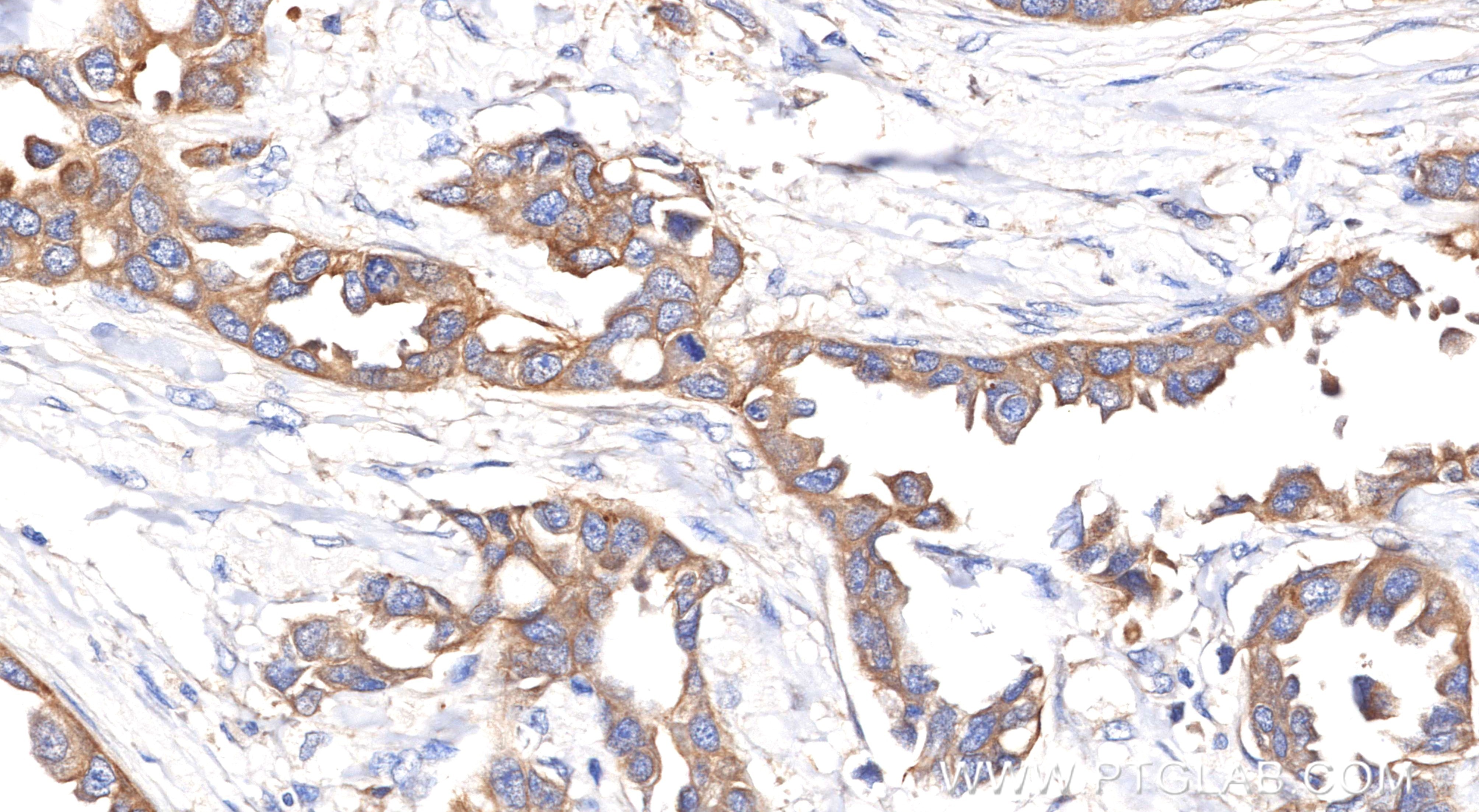 Immunohistochemical analysis of paraffin-embedded Human Breast Cancer(Her2+;ER-;PR-) slide using 86370-1-RR (Pan-Keratin (TypeⅡ) antibody) at dilution of 1:1000 (under 40x lens). Heat mediated antigen retrieval with Tris-EDTA buffer (pH 9.0). Immunohistochemistry (IHC) staining of Human Breast Cancer(Her2+;ER-;PR-) using Pan-Keratin (TypeⅡ) Recombinant monoclonal antibod (86370-1-RR)