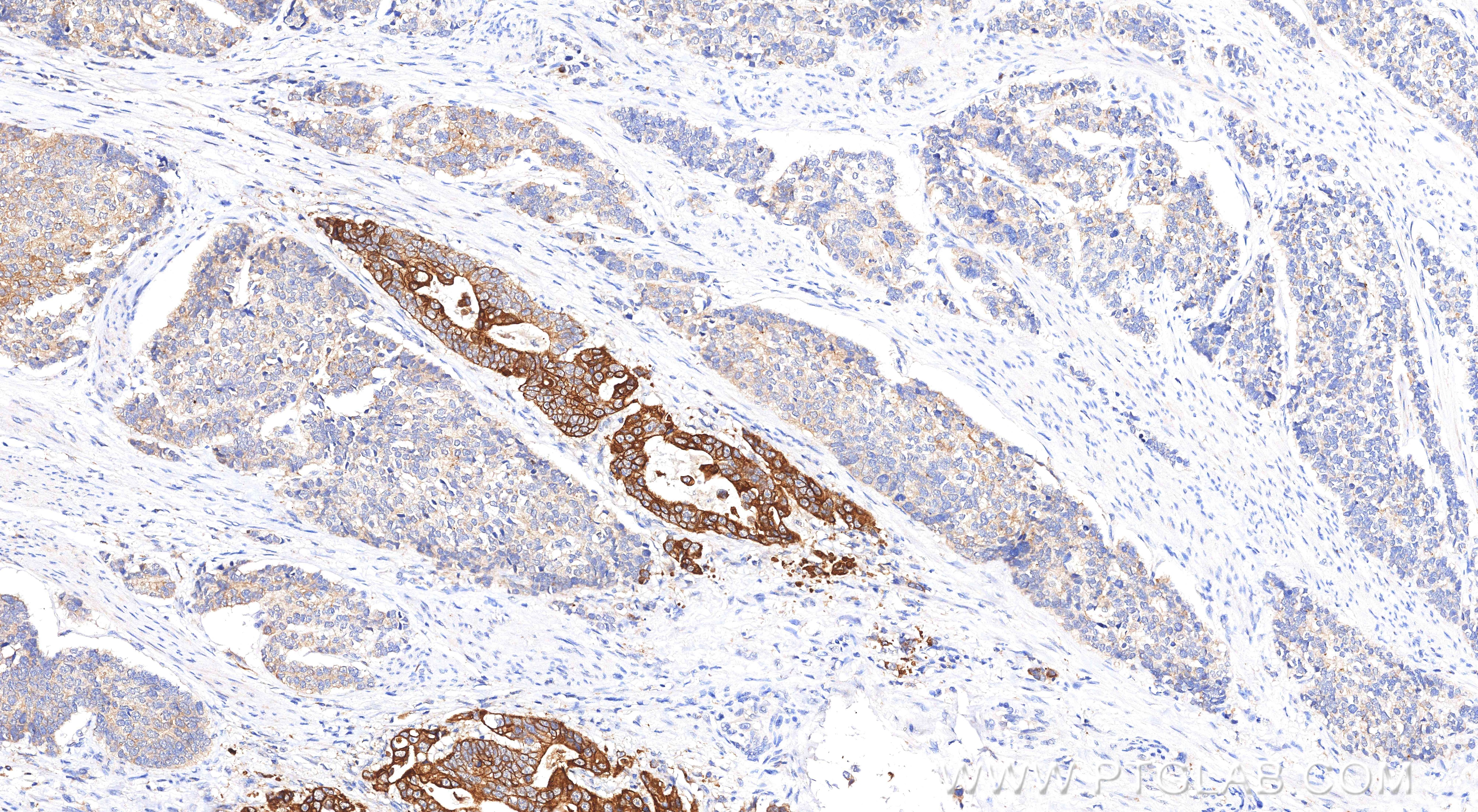 Immunohistochemical analysis of paraffin-embedded human stomach cancer tissue slide using 86370-1-RR (Pan-Keratin (TypeⅡ) antibody) at dilution of 1:1000 (under 10x lens). Heat mediated antigen retrieval with Tris-EDTA buffer (pH 9.0). Immunohistochemistry (IHC) staining of human stomach cancer tissue using Pan-Keratin (TypeⅡ) Recombinant monoclonal antibod (86370-1-RR)