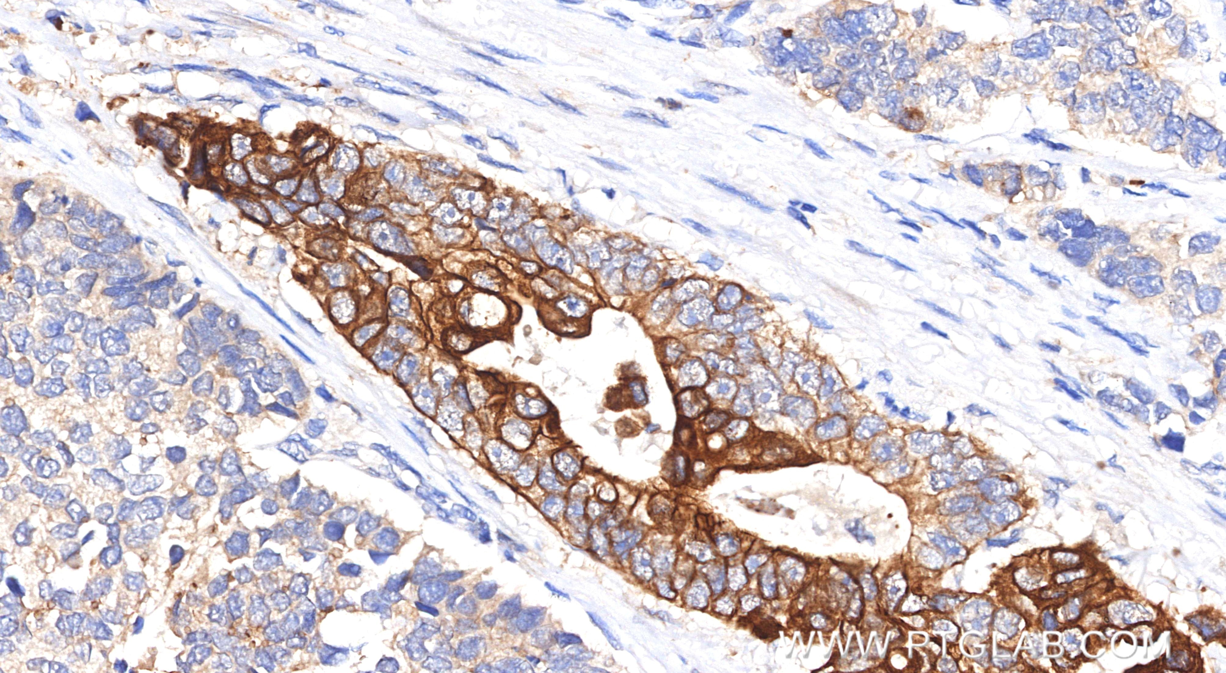 Immunohistochemical analysis of paraffin-embedded human stomach cancer tissue slide using 86370-1-RR (Pan-Keratin (TypeⅡ) antibody) at dilution of 1:1000 (under 40x lens). Heat mediated antigen retrieval with Tris-EDTA buffer (pH 9.0). Immunohistochemistry (IHC) staining of human stomach cancer tissue using Pan-Keratin (TypeⅡ) Recombinant monoclonal antibod (86370-1-RR)