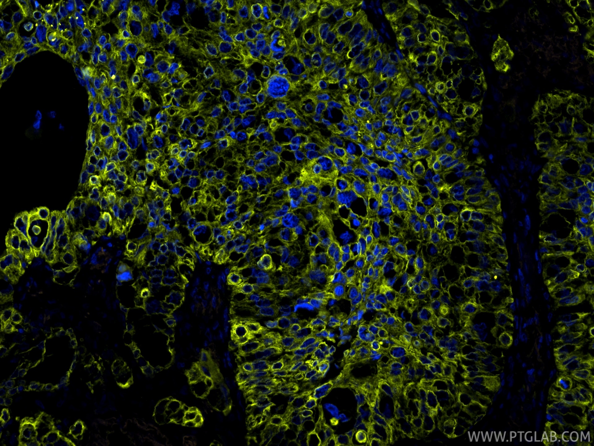 IF Staining of human lung cancer using PE-86370 Immunofluorescence (IF) / fluorescent staining of human lung cancer tissue using PE-conjugated Pan-Keratin (TypeⅡ) Recombinant mono (PE-86370)