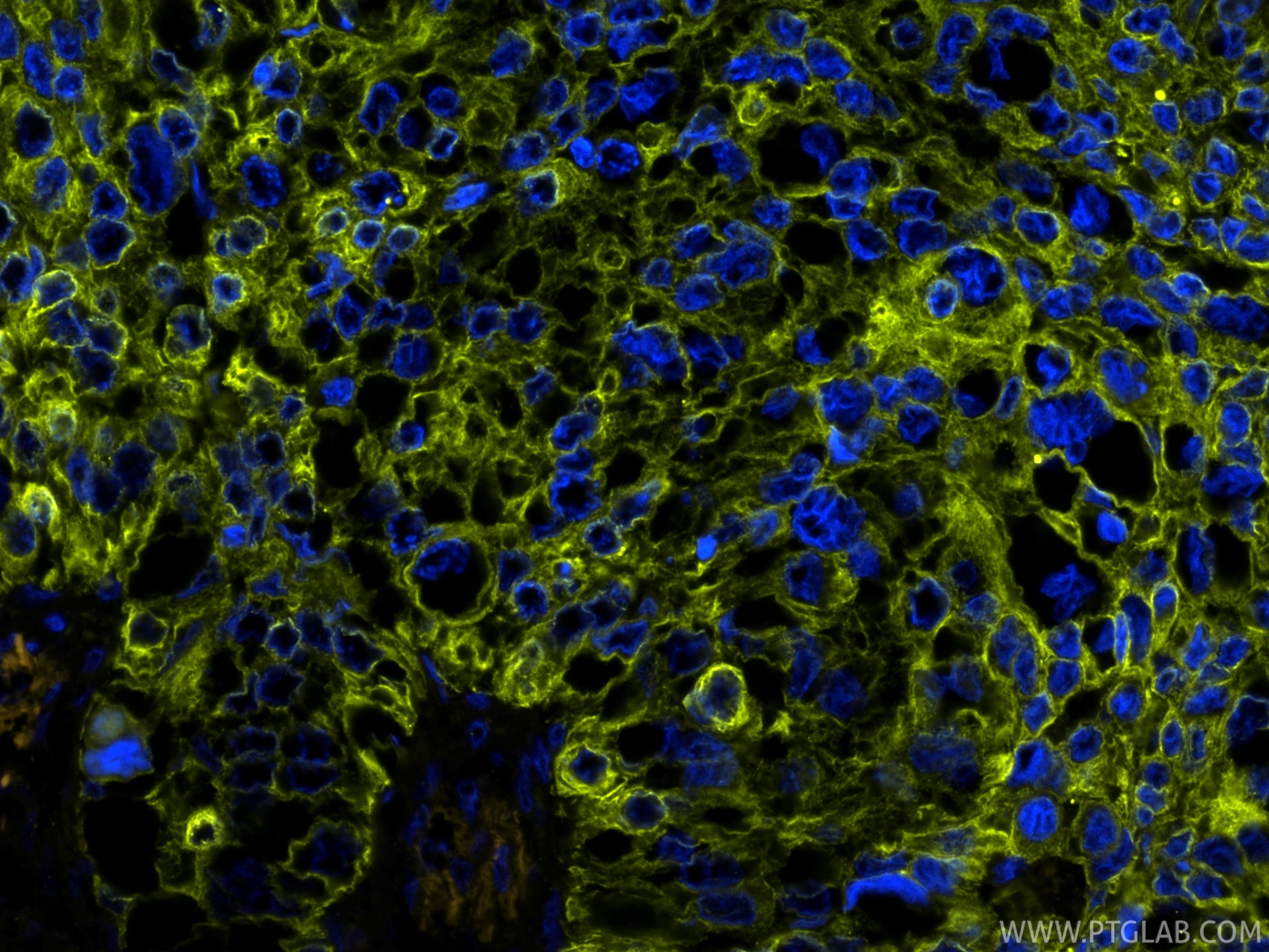 IF Staining of human lung cancer using PE-86370 Immunofluorescence (IF) / fluorescent staining of human lung cancer tissue using PE-conjugated Pan-Keratin (TypeⅡ) Recombinant mono (PE-86370)