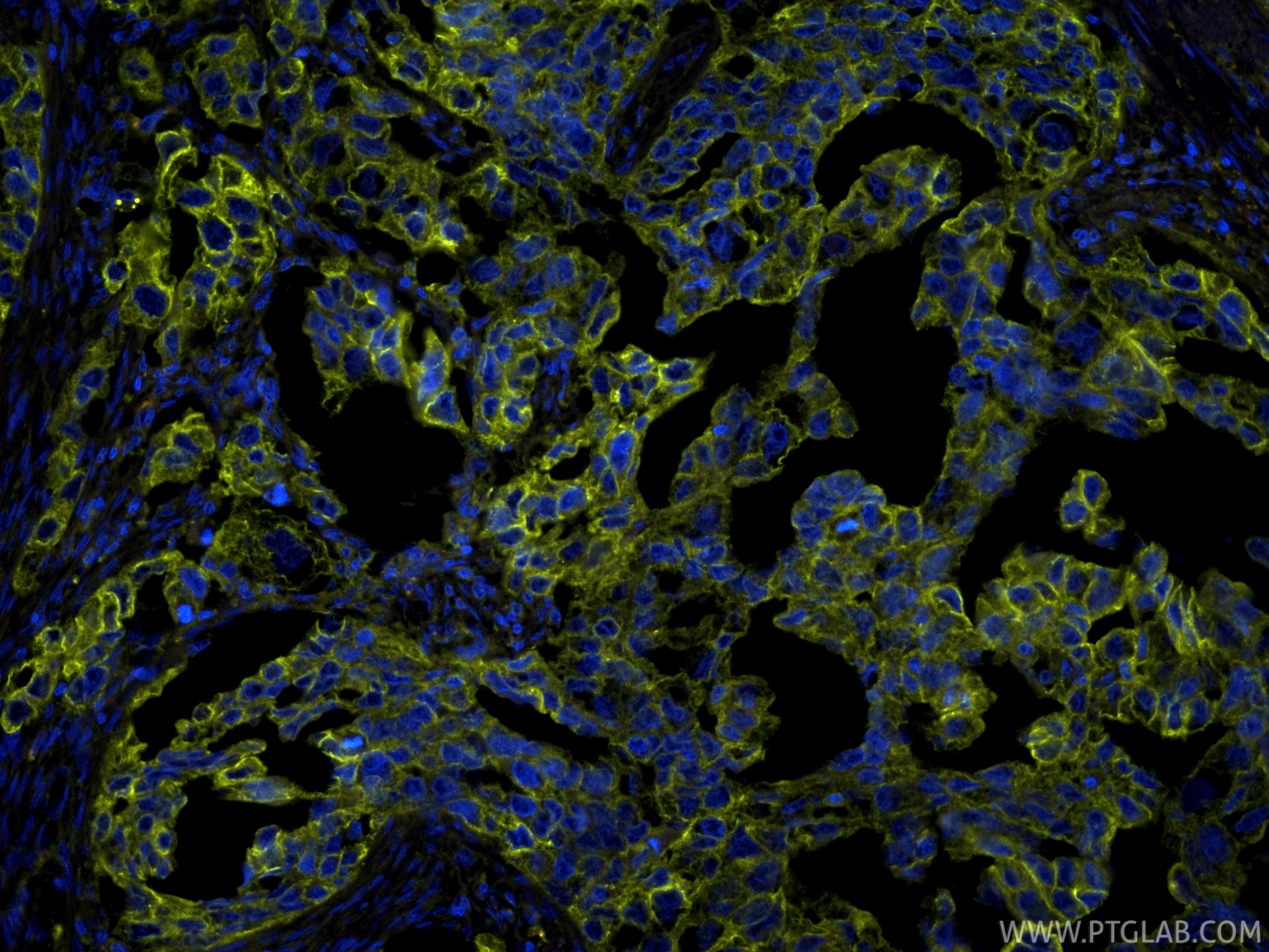 IF Staining of human colon cancer using PE-86370 Immunofluorescence (IF) / fluorescent staining of human colon cancer tissue using PE-conjugated Pan-Keratin (TypeⅡ) Recombinant mono (PE-86370)