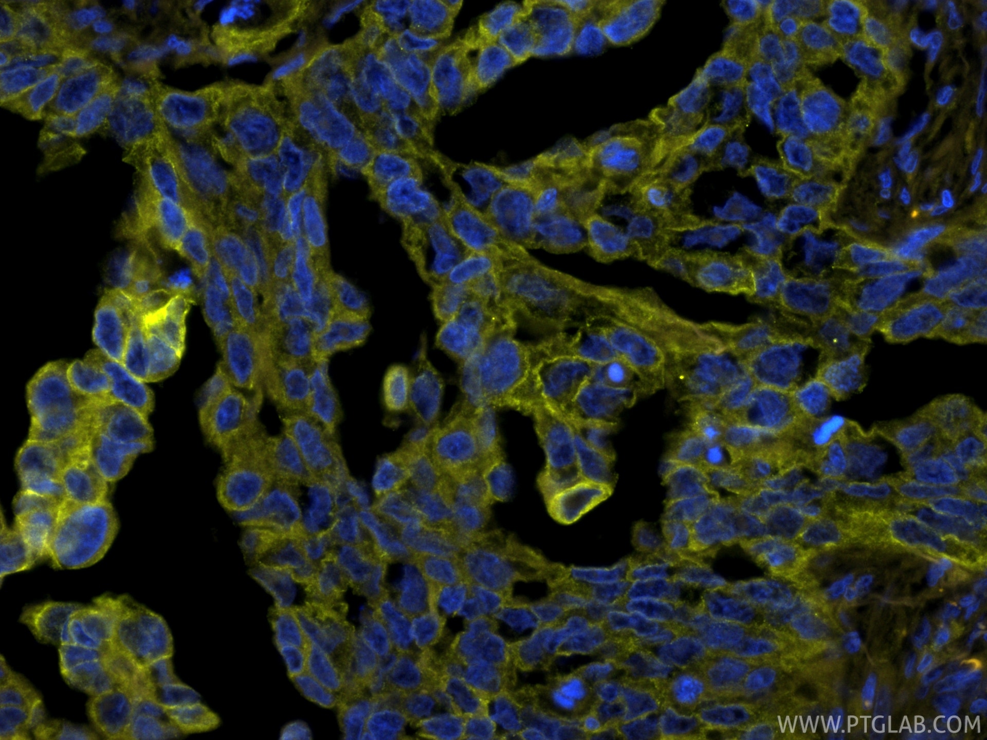 IF Staining of human colon cancer using PE-86370 Immunofluorescence (IF) / fluorescent staining of human colon cancer tissue using PE-conjugated Pan-Keratin (TypeⅡ) Recombinant mono (PE-86370)