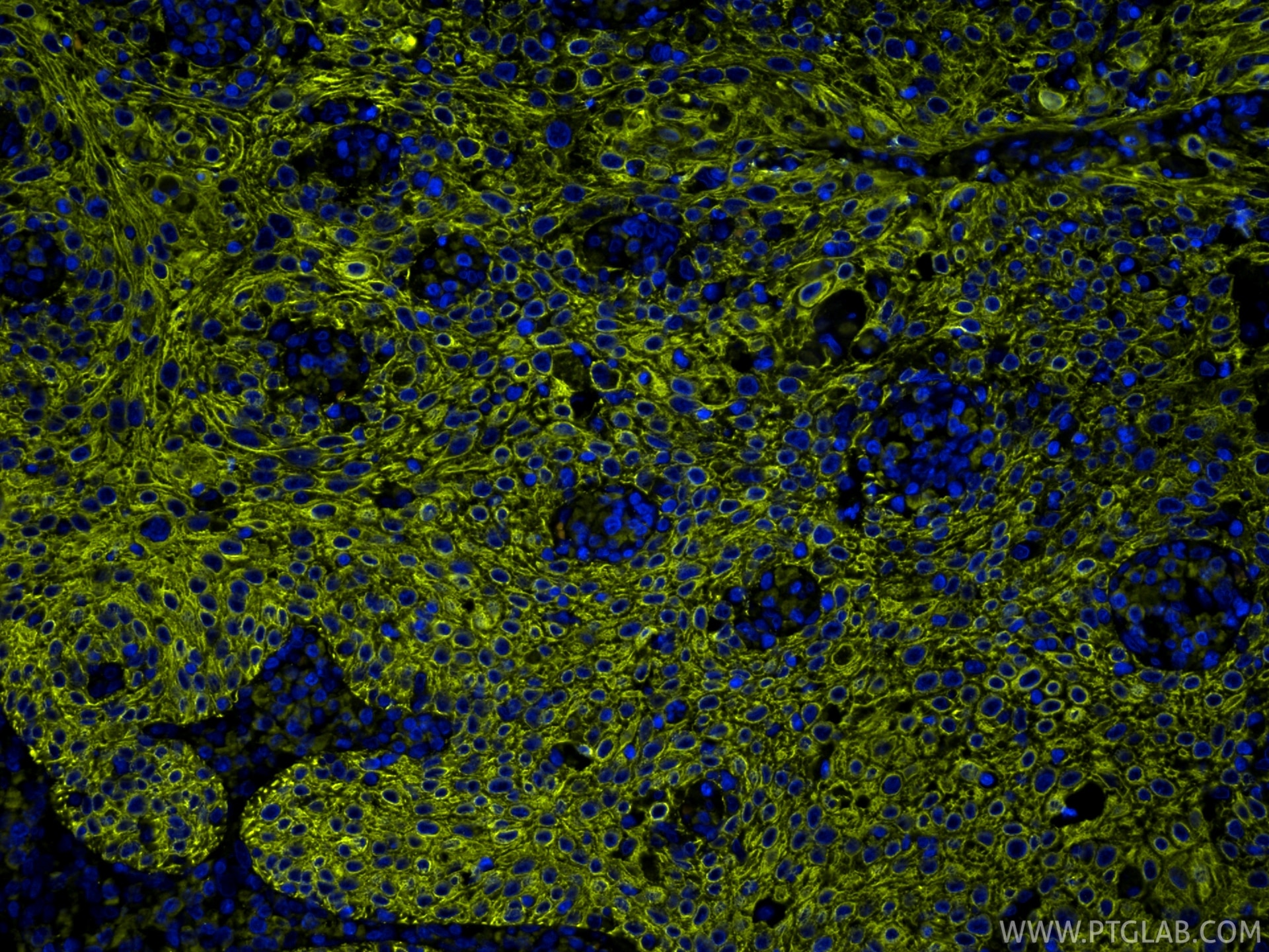 IF Staining of human cervical cancer using PE-86370 Immunofluorescence (IF) / fluorescent staining of human cervical cancer tissue using PE-conjugated Pan-Keratin (TypeⅡ) Recombinant mono (PE-86370)