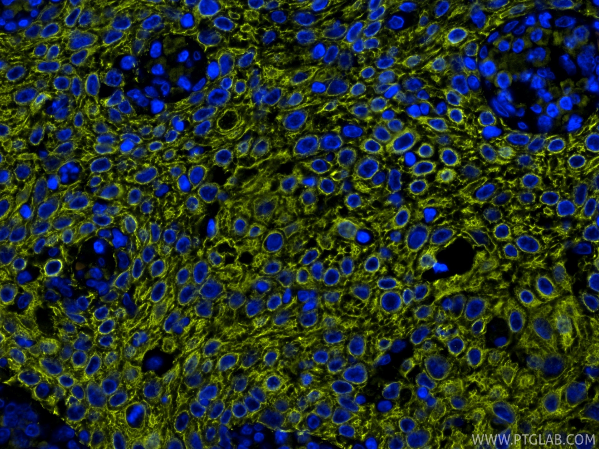 IF Staining of human cervical cancer using PE-86370 Immunofluorescence (IF) / fluorescent staining of human cervical cancer tissue using PE-conjugated Pan-Keratin (TypeⅡ) Recombinant mono (PE-86370)