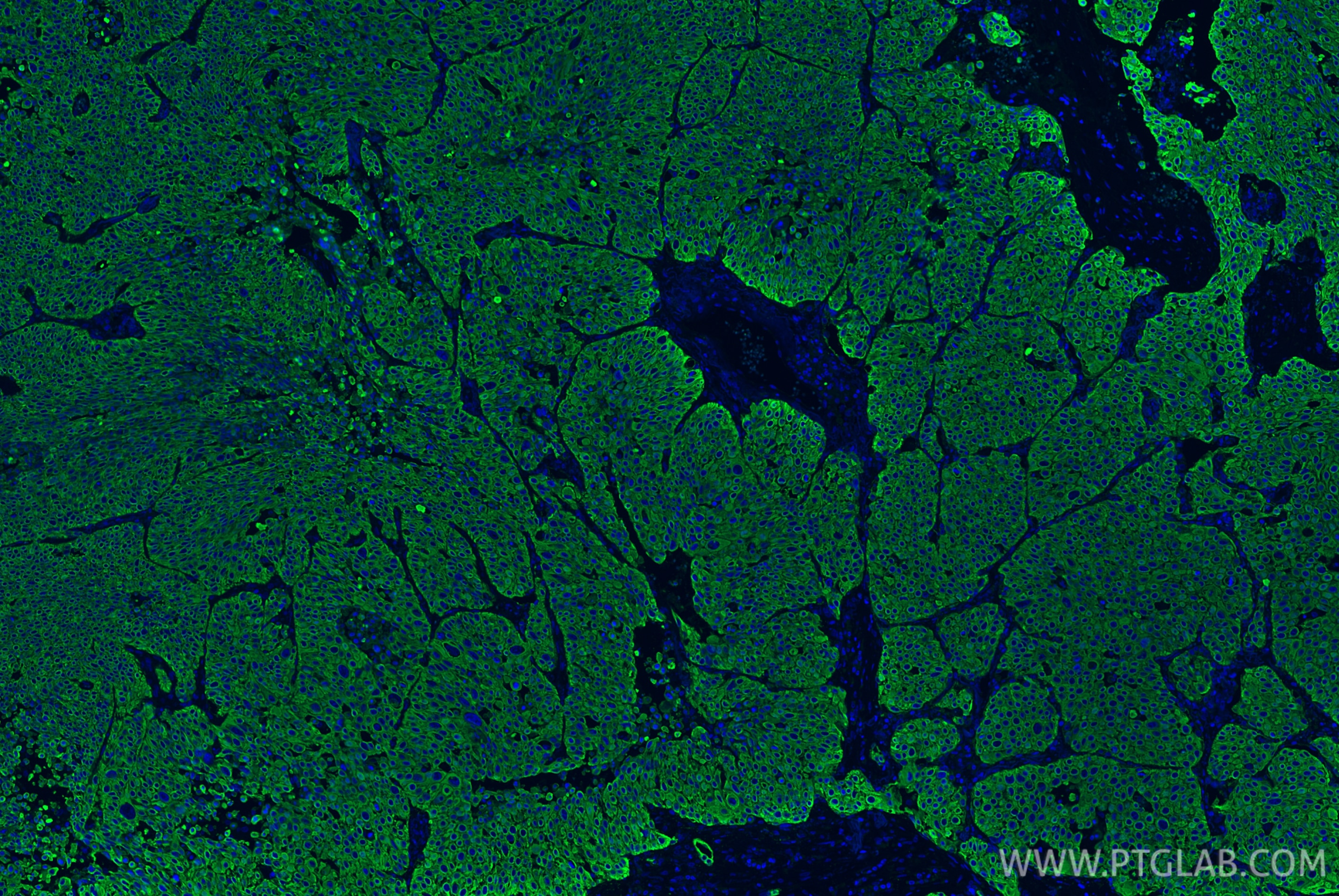 Immunofluorescent analysis of (4% PFA) fixed paraffin-embedded human lung cancer tissue using Pan-Keratin (Type I) antibody (86238-2-RR, Clone: 251039C1 ) at dilution of 1:500 and CoraLite®488-Conjugated Goat Anti-Rabbit IgG(H+L) (SA00013-2). Heat mediated antigen retrieval with Tris-EDTA buffer (pH 9.0). Immunofluorescence (IF) / fluorescent staining of human lung cancer tissue using Pan-Keratin (Type I) Recombinant antibody (86238-2-RR)