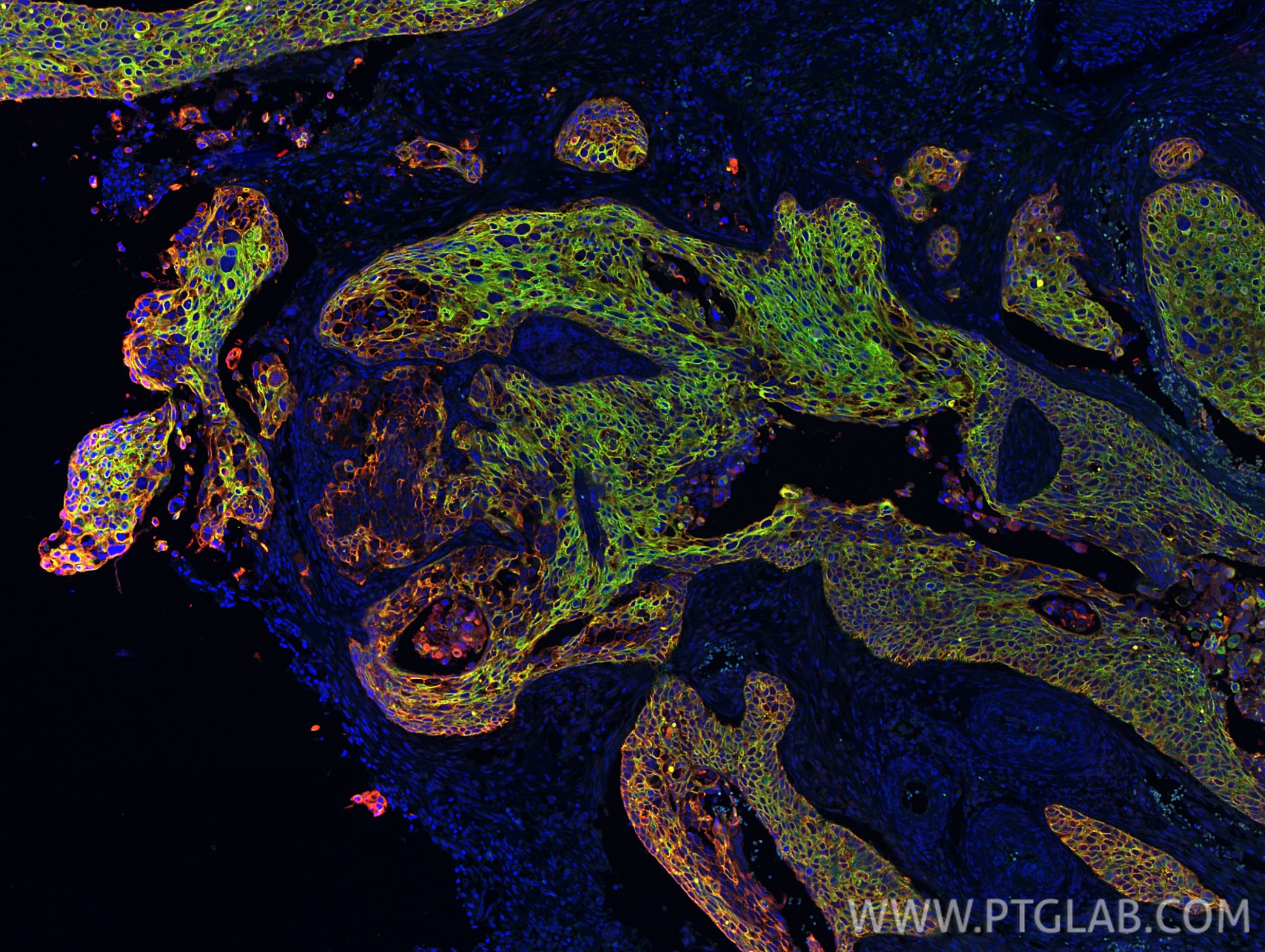 Immunofluorescent analysis of (4% PFA) fixed paraffin-embedded human cervical cancer tissue using Pan-Keratin (Type I) antibody (86238-2-RR, Clone: 251039C1 ) at dilution of 1:500 and CoraLite®594-Conjugated Goat Anti-Rabbit IgG(H+L) (SA00013-4), Pan-Keratin (TypeⅡ) antibody 86370-1-RR labeled with FlexAble 2.0 CoraLite® Plus 488 Kit (KFA501, green). Heat mediated antigen retrieval with Tris-EDTA buffer (pH 9.0). Immunofluorescence (IF) / fluorescent staining of human cervical cancer tissue using Pan-Keratin (Type I) Recombinant antibody (86238-2-RR)