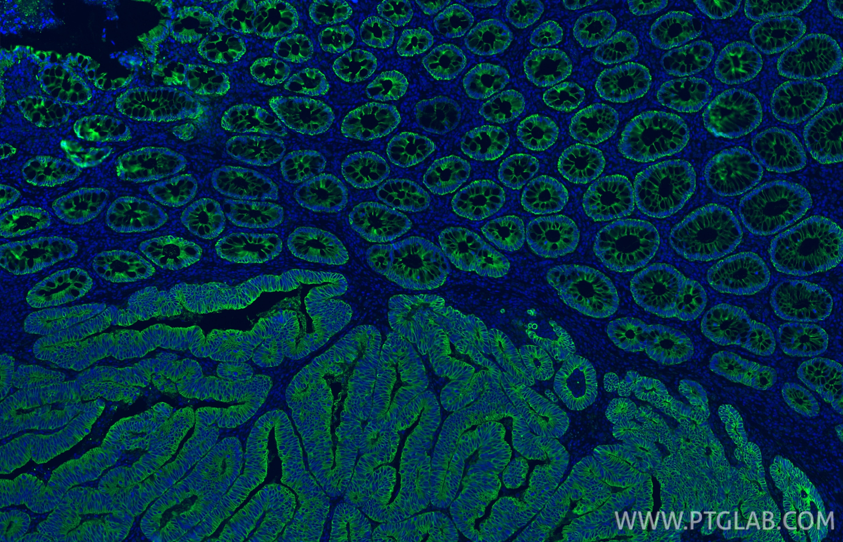 Immunofluorescent analysis of (4% PFA) fixed paraffin-embedded human colon cancer tissue using Pan-Keratin (Type I) antibody (86238-2-RR, Clone: 251039C1 ) at dilution of 1:500 and CoraLite®488-Conjugated Goat Anti-Rabbit IgG(H+L) (SA00013-2). Heat mediated antigen retrieval with Tris-EDTA buffer (pH 9.0). Immunofluorescence (IF) / fluorescent staining of human colon cancer tissue using Pan-Keratin (Type I) Recombinant antibody (86238-2-RR)