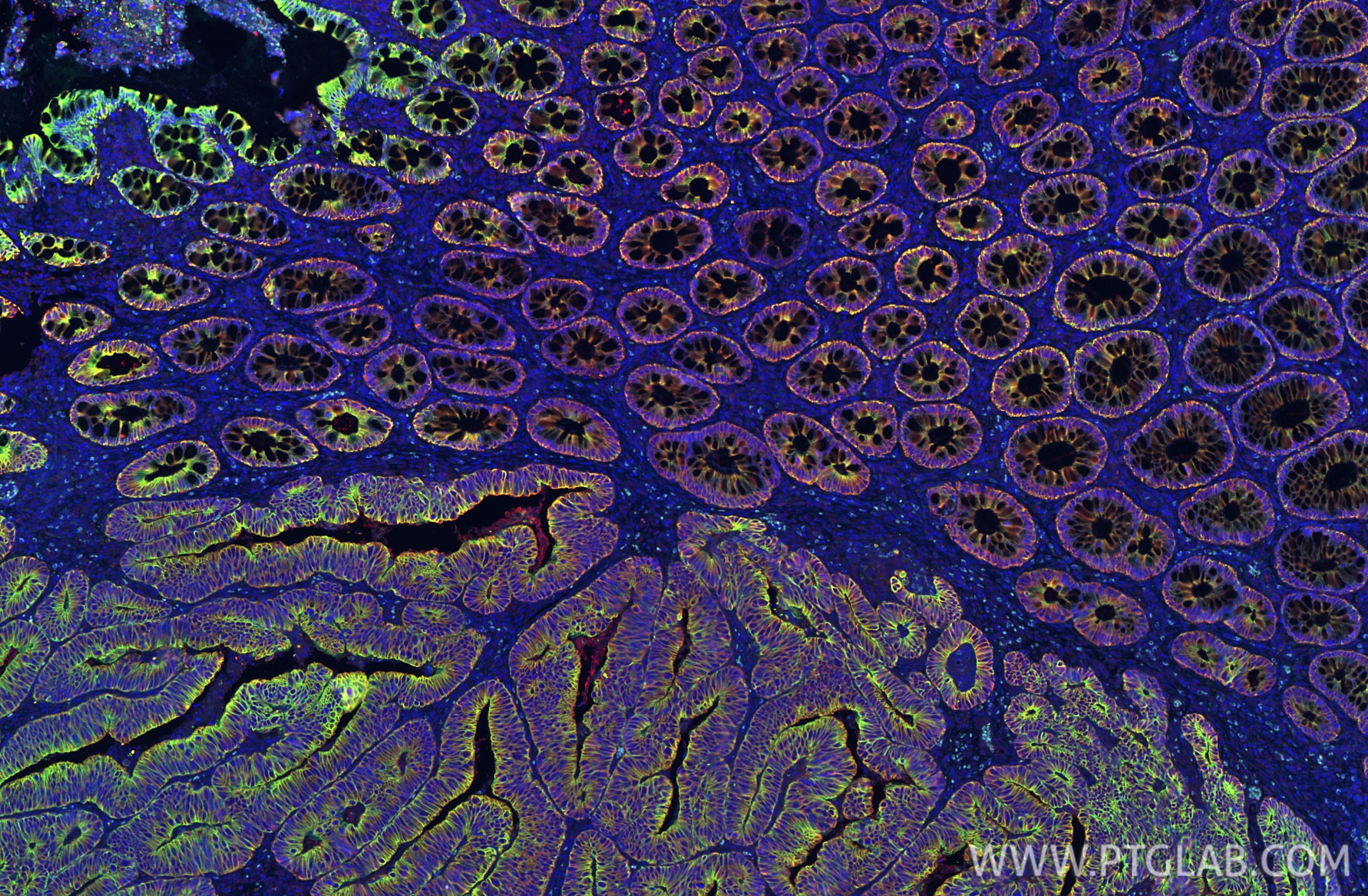 Immunofluorescent analysis of (4% PFA) fixed paraffin-embedded human cervical cancer tissue using Pan-Keratin (Type I) antibody (86238-2-RR, Clone: 251039C1 ) at dilution of 1:500 and CoraLite®594-Conjugated Goat Anti-Rabbit IgG(H+L) (SA00013-4), Pan-Keratin (TypeⅡ) antibody 86370-1-RR labeled with FlexAble 2.0 CoraLite® Plus 488 Kit (KFA501, green). Heat mediated antigen retrieval with Tris-EDTA buffer (pH 9.0). Immunofluorescence (IF) / fluorescent staining of human colon cancer tissue using Pan-Keratin (Type I) Recombinant monoclonal antibo (86238-2-RR)