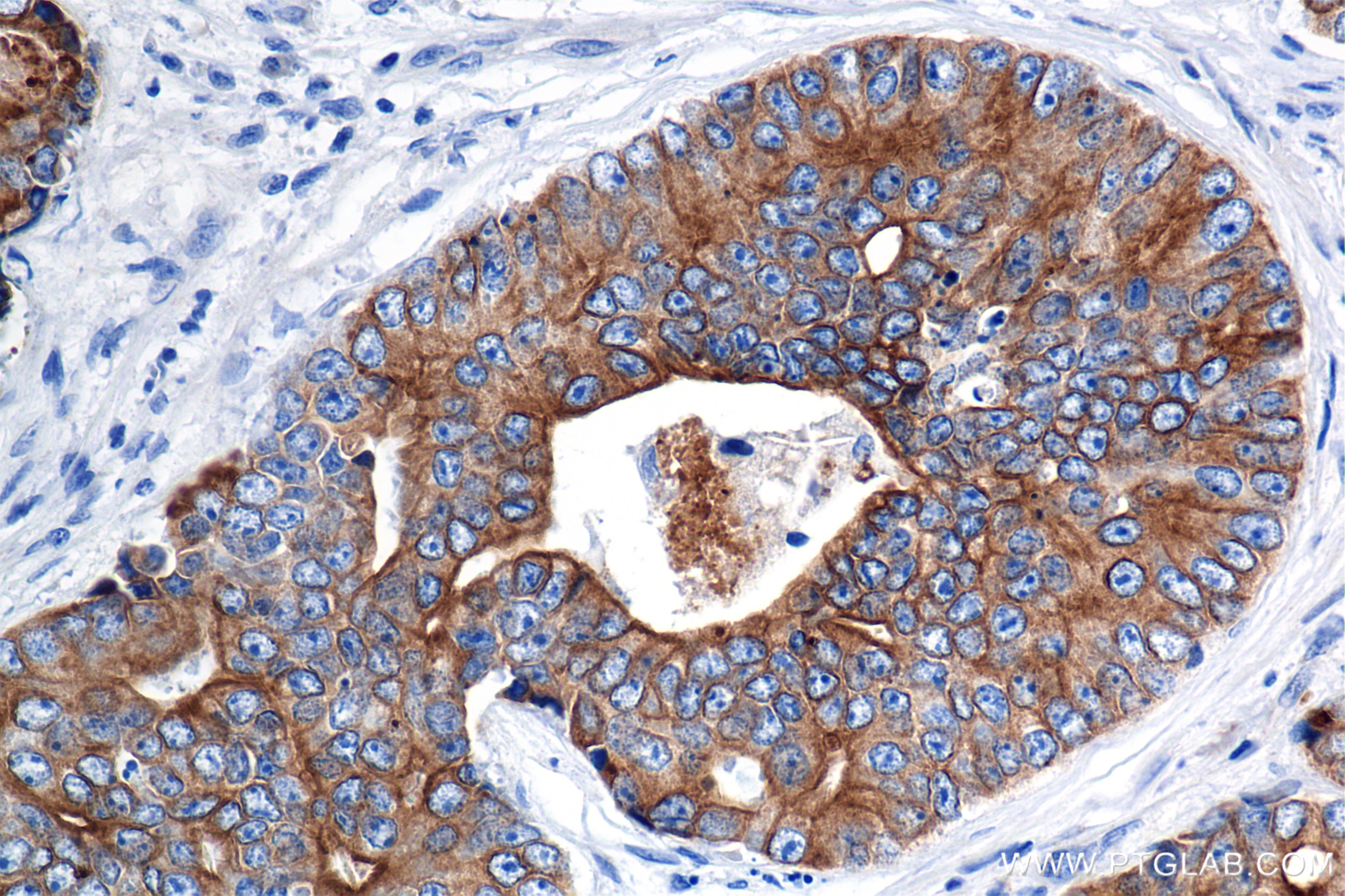 Immunohistochemical analysis of paraffin-embedded human prostate cancer tissue slide using 86238-2-RR (Pan-Keratin (Type I) antibody) at dilution of 1:1000 (under 40x lens). Heat mediated antigen retrieval with Tris-EDTA buffer (pH 9.0). Immunohistochemistry (IHC) staining of human prostate cancer tissue using Pan-Keratin (Type I) Recombinant antibody (86238-2-RR)