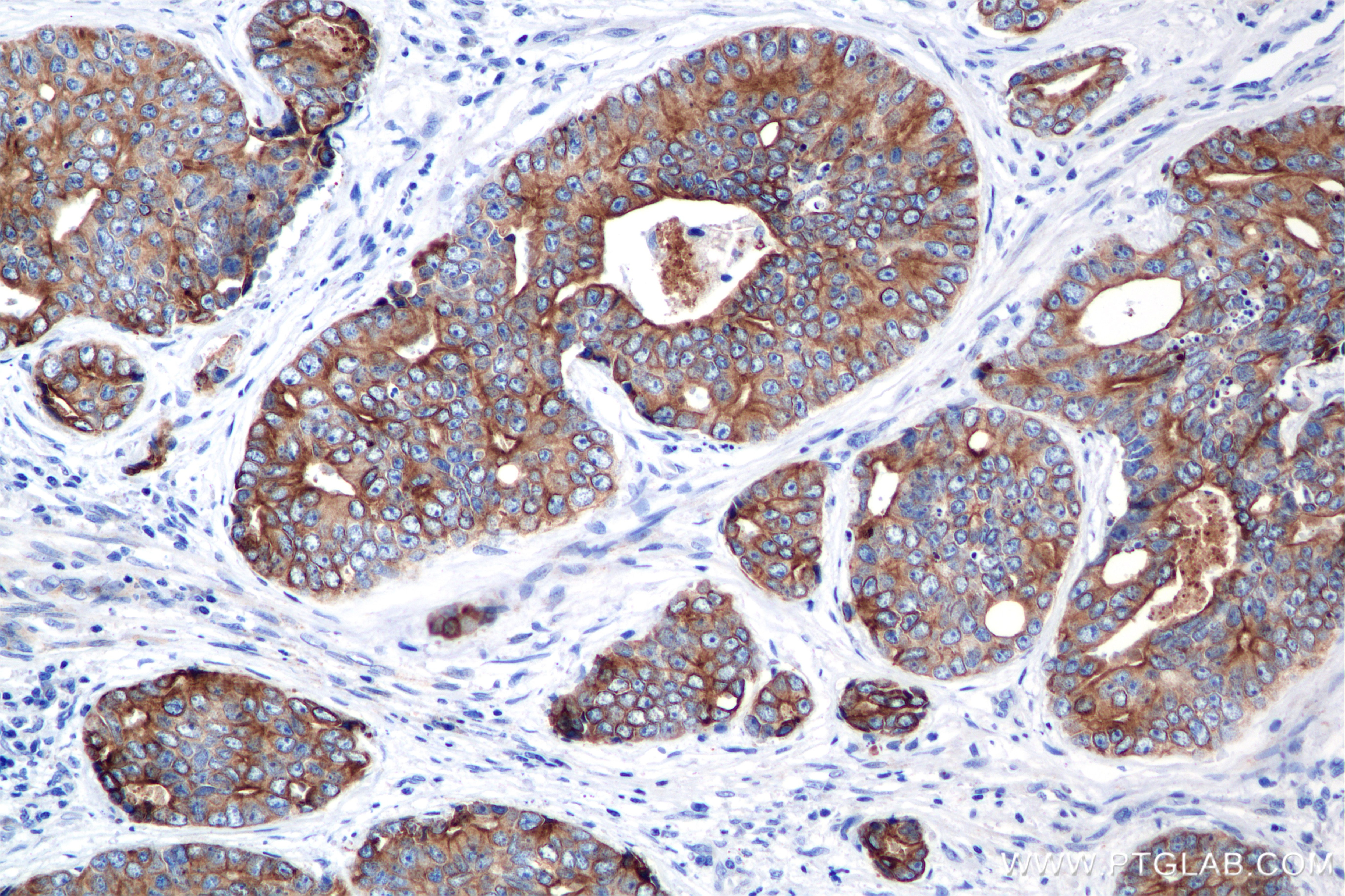 Immunohistochemical analysis of paraffin-embedded human prostate cancer tissue slide using 86238-2-RR (Pan-Keratin (Type I) antibody) at dilution of 1:1000 (under 20x lens). Heat mediated antigen retrieval with Tris-EDTA buffer (pH 9.0). Immunohistochemistry (IHC) staining of human prostate cancer tissue using Pan-Keratin (Type I) Recombinant antibody (86238-2-RR)