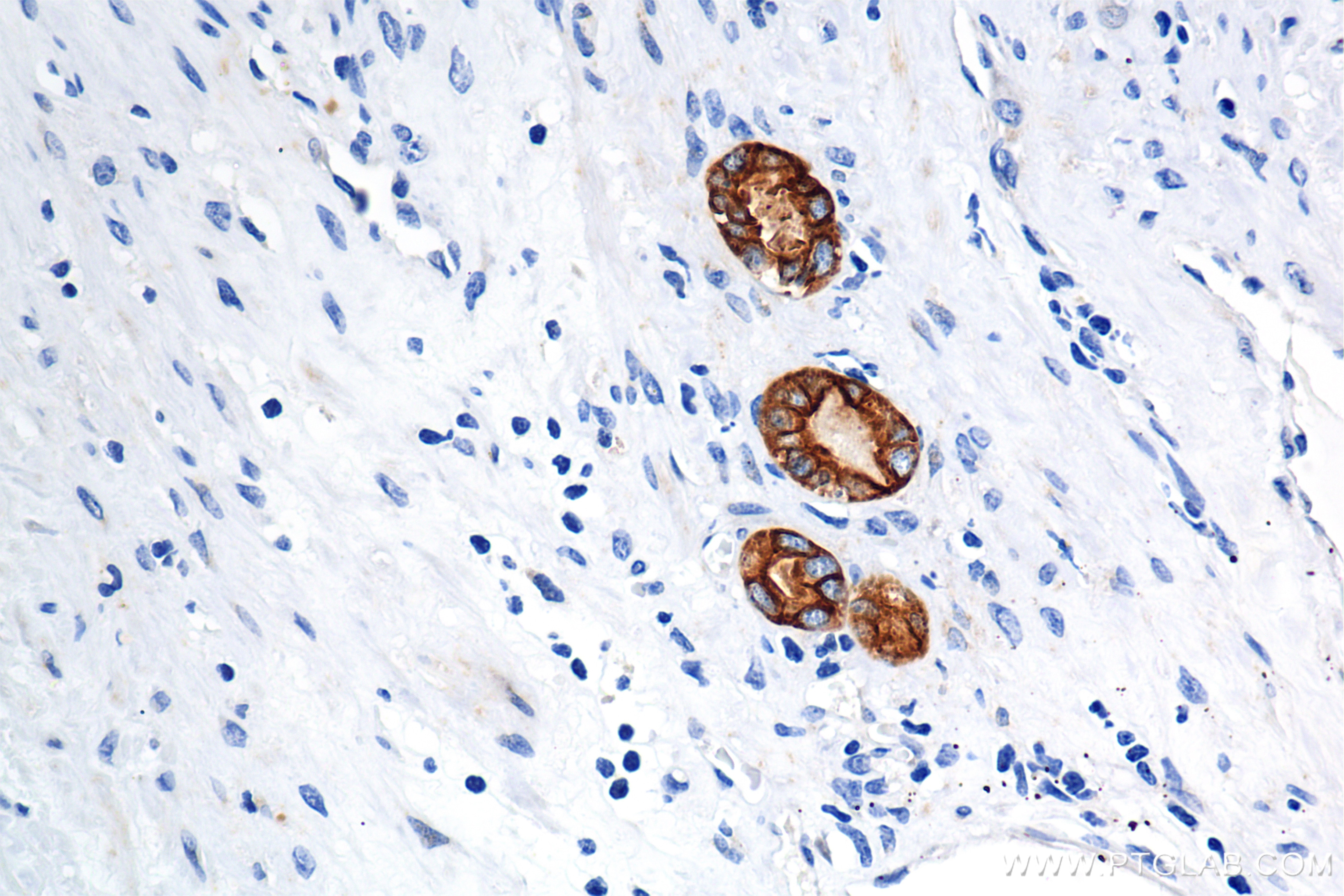 Immunohistochemical analysis of paraffin-embedded Human Kidney(renal cell) Cancer slide using 86238-2-RR (Pan-Keratin (Type I) antibody) at dilution of 1:1000 (under 40x lens). Heat mediated antigen retrieval with Tris-EDTA buffer (pH 9.0). Immunohistochemistry (IHC) staining of Human Kidney(renal cell) Cancer using Pan-Keratin (Type I) Recombinant antibody (86238-2-RR)