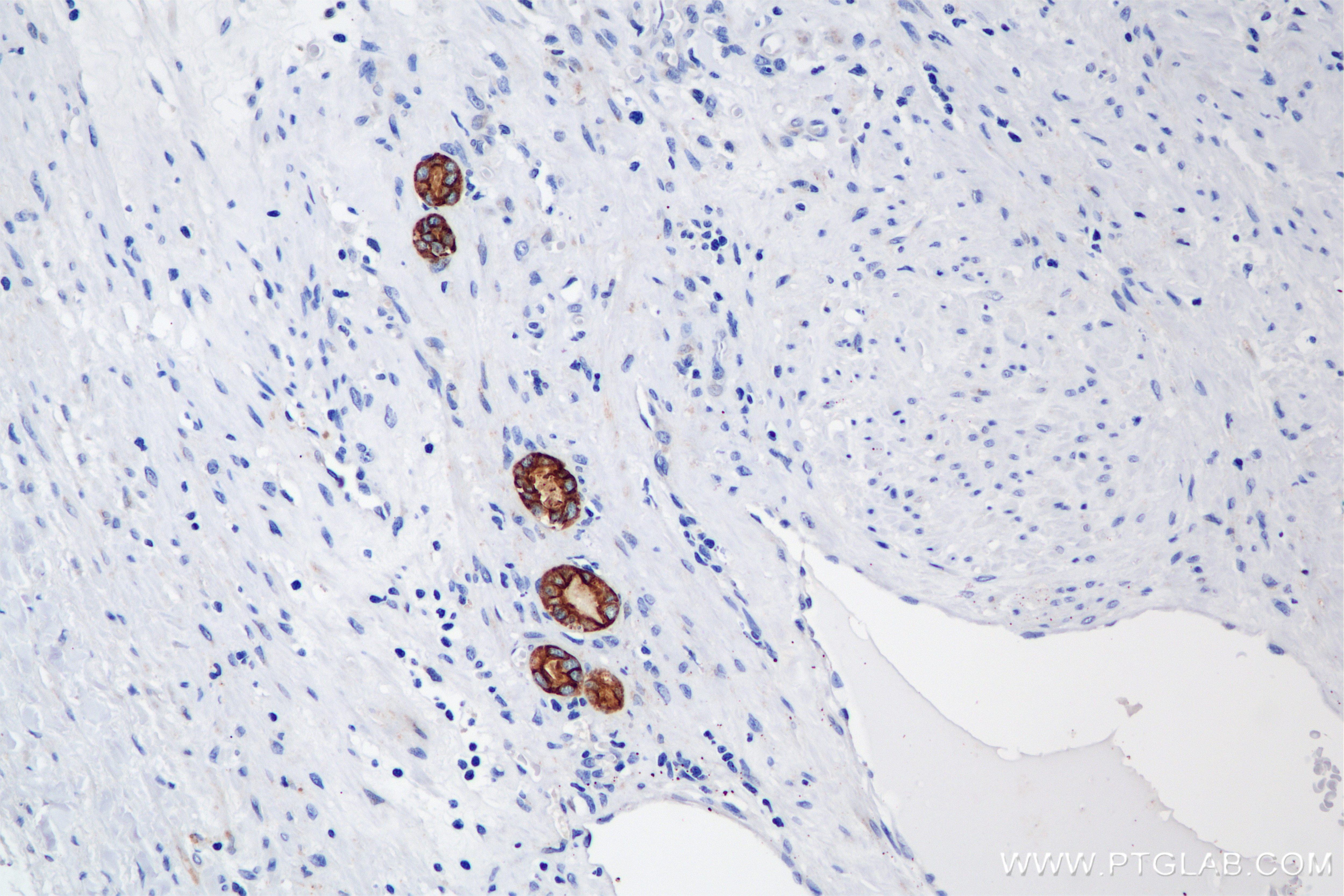 Immunohistochemical analysis of paraffin-embedded Human Kidney(renal cell) Cancer slide using 86238-2-RR (Pan-Keratin (Type I) antibody) at dilution of 1:1000 (under 20x lens). Heat mediated antigen retrieval with Tris-EDTA buffer (pH 9.0). Immunohistochemistry (IHC) staining of Human Kidney(renal cell) Cancer using Pan-Keratin (Type I) Recombinant antibody (86238-2-RR)
