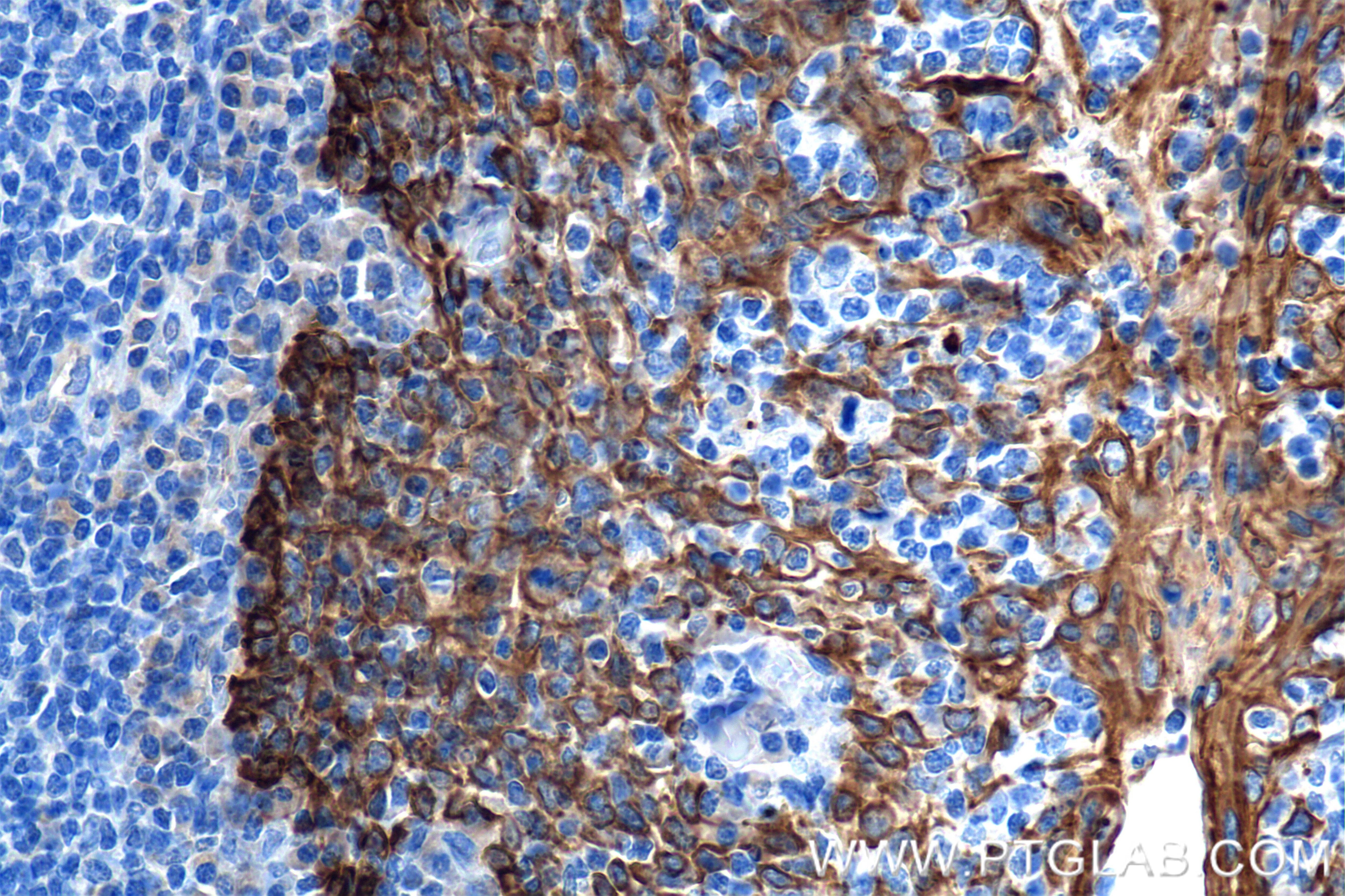 Immunohistochemical analysis of paraffin-embedded human tonsil tissue slide using 86238-2-RR (Pan-Keratin (Type I) antibody) at dilution of 1:1000 (under 40x lens). Heat mediated antigen retrieval with Tris-EDTA buffer (pH 9.0). Immunohistochemistry (IHC) staining of human tonsil tissue using Pan-Keratin (Type I) Recombinant antibody (86238-2-RR)