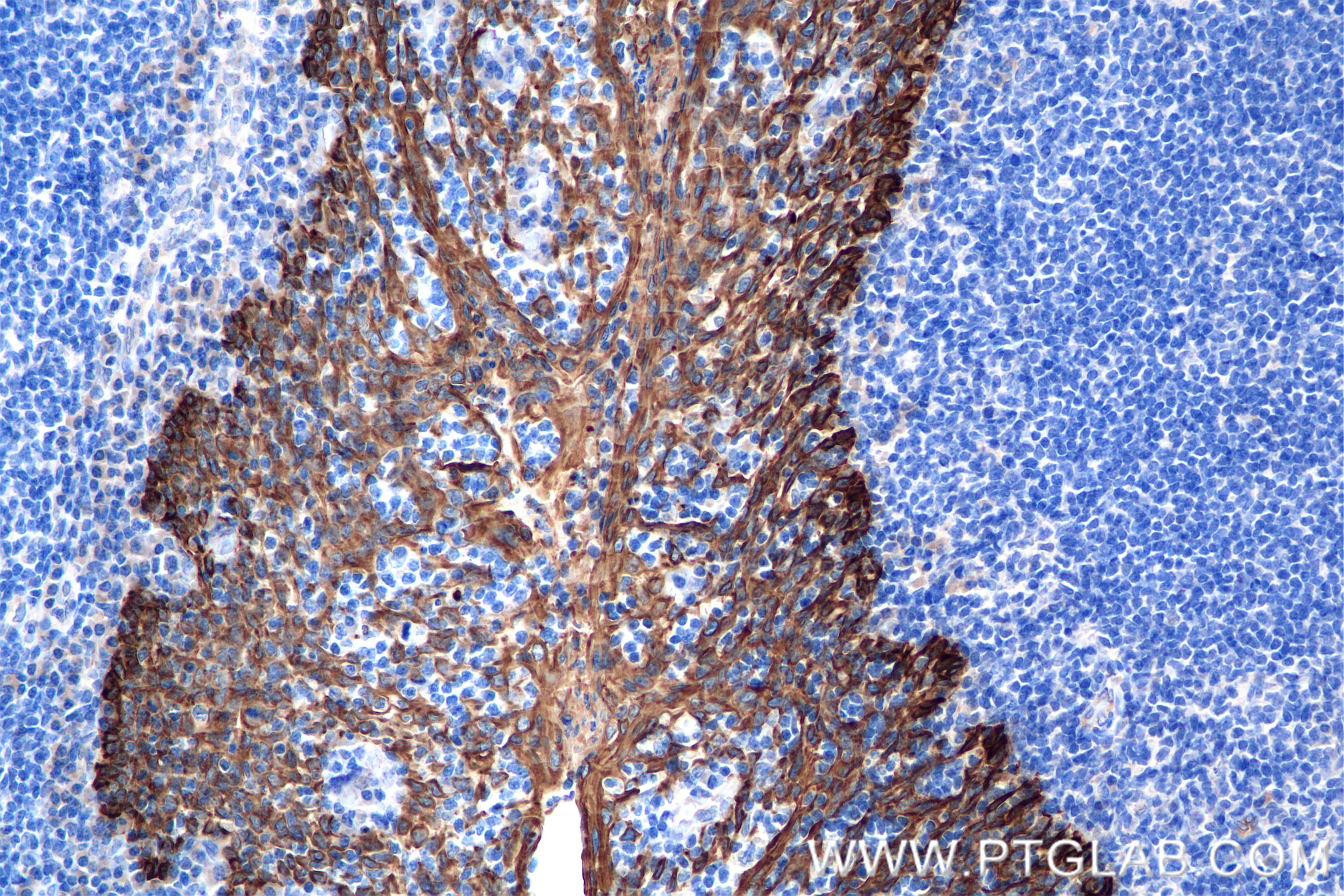 Immunohistochemical analysis of paraffin-embedded human tonsil tissue slide using 86238-2-RR (Pan-Keratin (Type I) antibody) at dilution of 1:1000 (under 20x lens). Heat mediated antigen retrieval with Tris-EDTA buffer (pH 9.0). Immunohistochemistry (IHC) staining of human tonsil tissue using Pan-Keratin (Type I) Recombinant antibody (86238-2-RR)