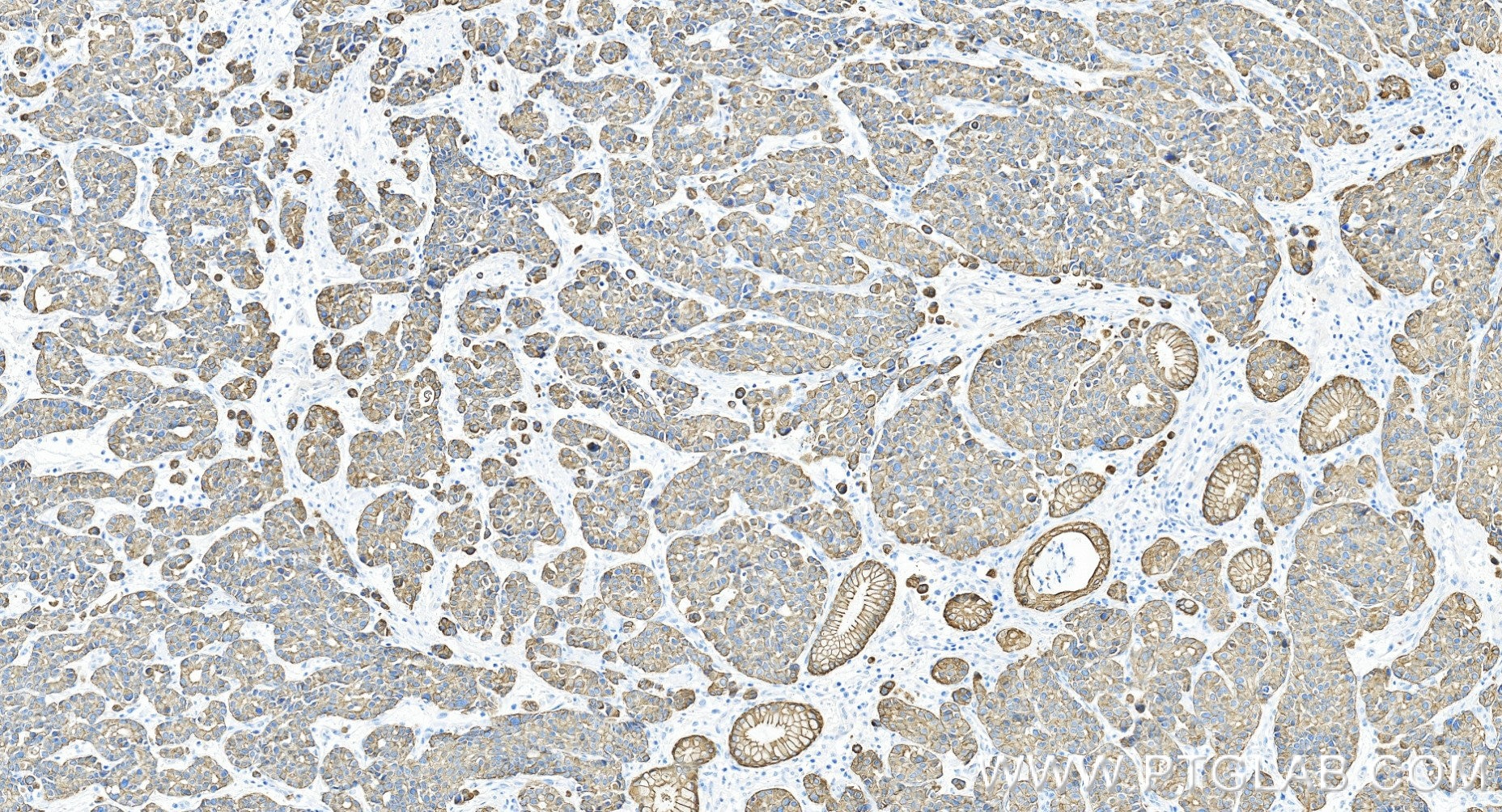 Immunohistochemistry (IHC) staining of human stomach cancer tissue using Pan-Keratin (Type I) Recombinant monoclonal antibo (86238-5-RR)