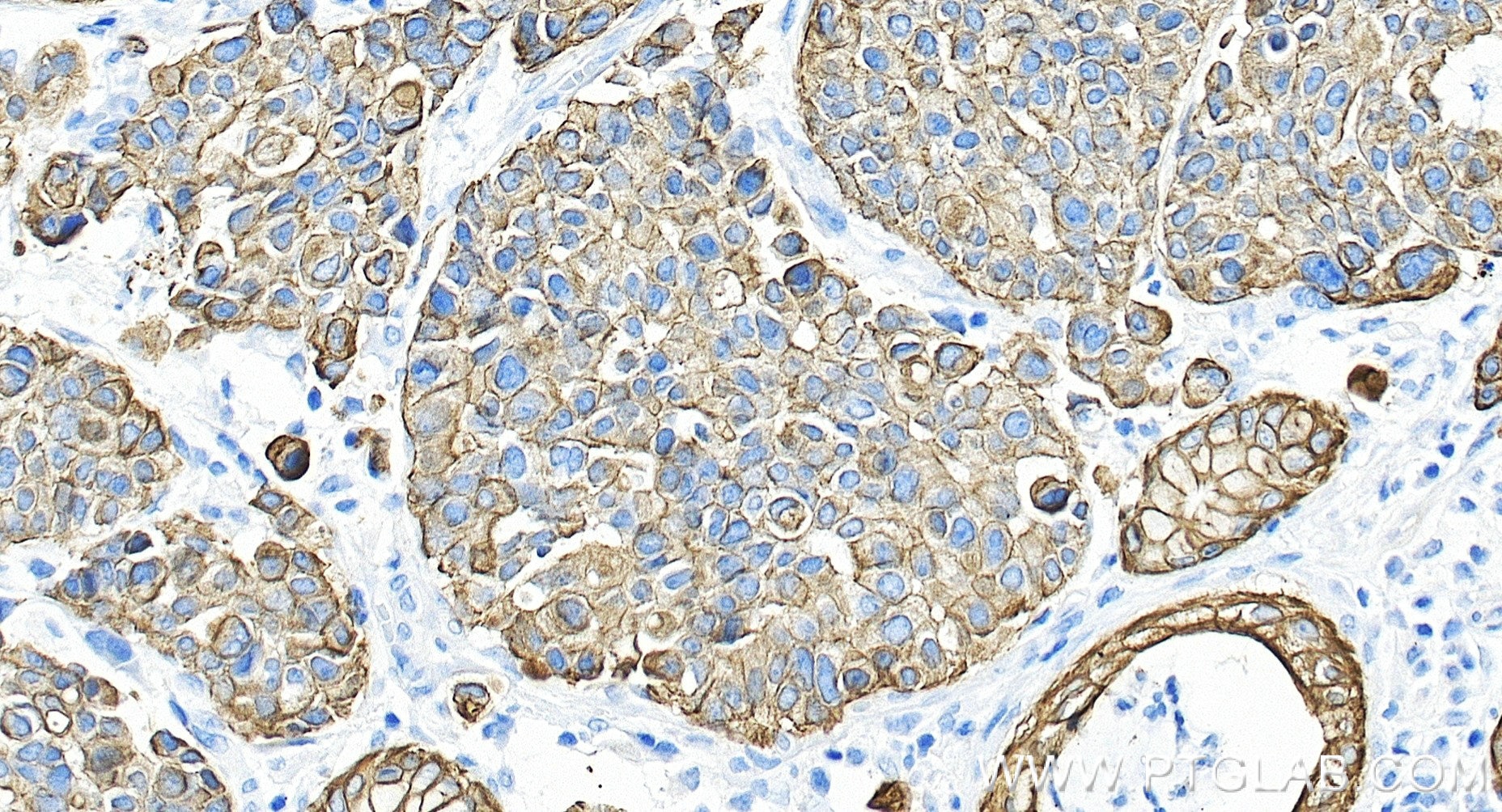 Immunohistochemistry (IHC) staining of human stomach cancer tissue using Pan-Keratin (Type I) Recombinant monoclonal antibo (86238-5-RR)