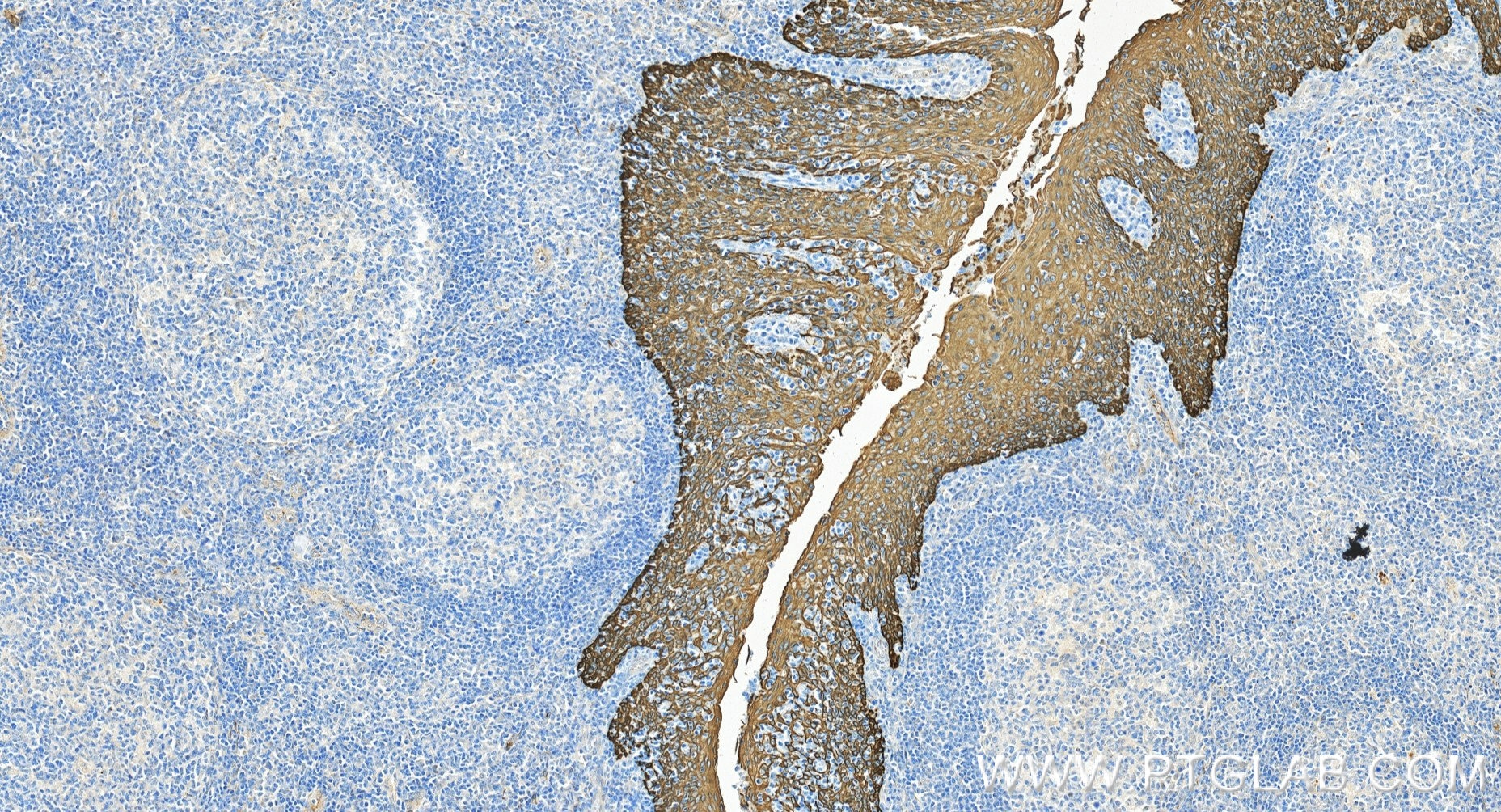 Immunohistochemistry (IHC) staining of human tonsillitis tissue using Pan-Keratin (Type I) Recombinant monoclonal antibo (86238-5-RR)