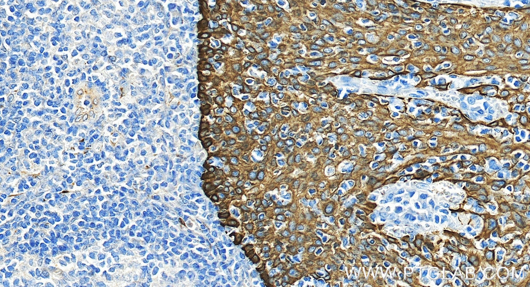 Immunohistochemistry (IHC) staining of human tonsillitis tissue using Pan-Keratin (Type I) Recombinant monoclonal antibo (86238-5-RR)