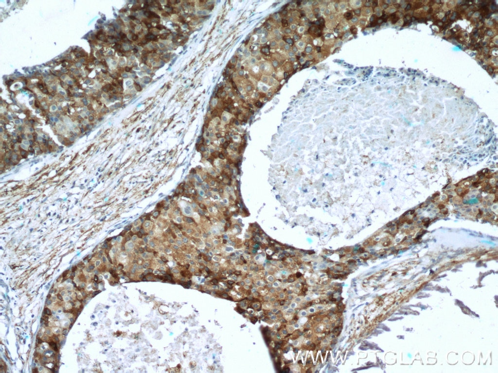 Immunohistochemistry (IHC) staining of human breast cancer tissue using Paxillin Polyclonal antibody (22172-1-AP)