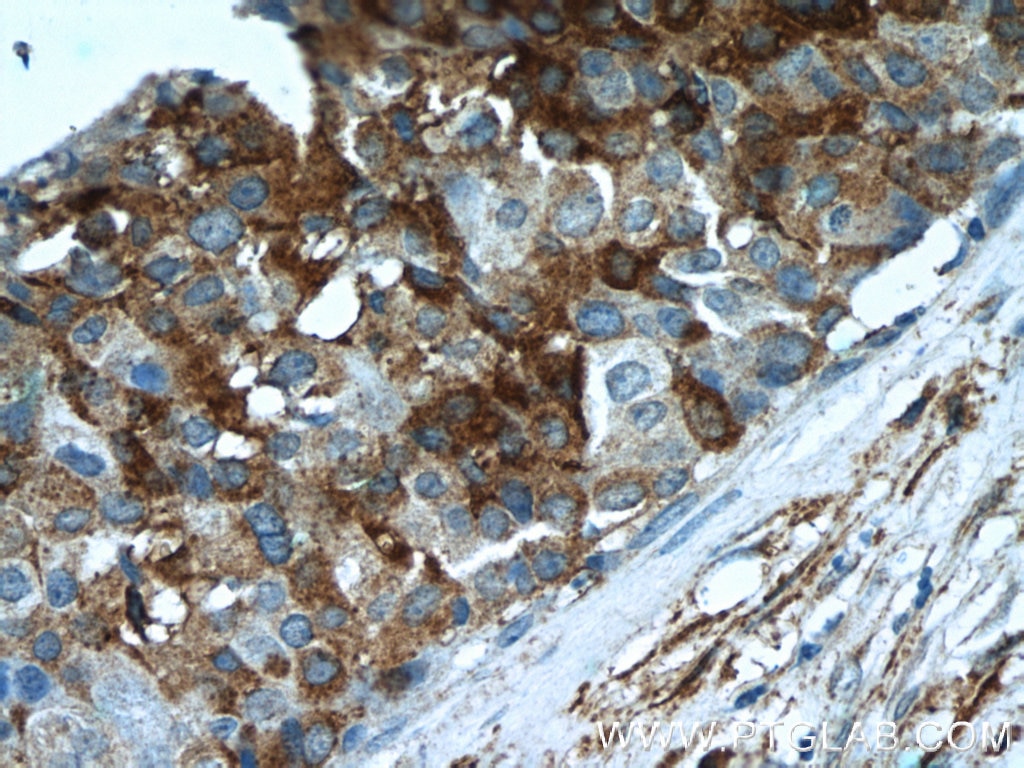 Immunohistochemistry (IHC) staining of human breast cancer tissue using Paxillin Polyclonal antibody (22172-1-AP)