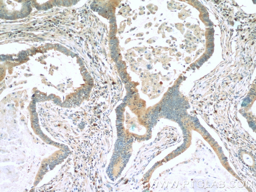 IHC staining of human stomach cancer using 22172-1-AP