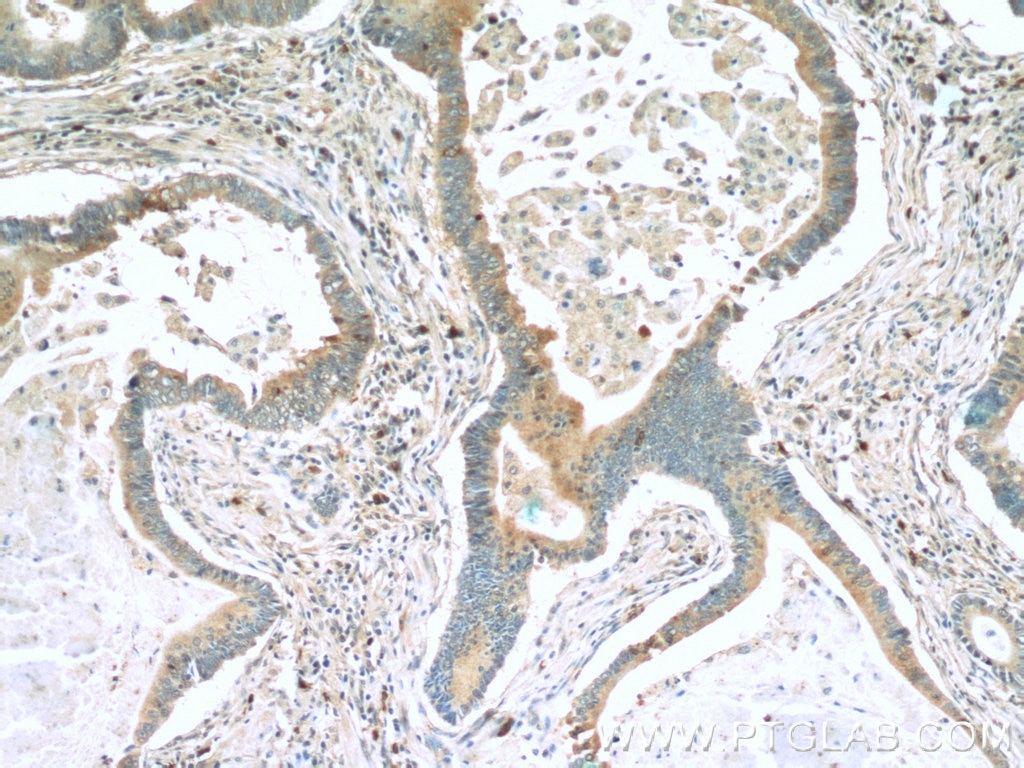 Immunohistochemistry (IHC) staining of human stomach cancer tissue using Paxillin Polyclonal antibody (22172-1-AP)