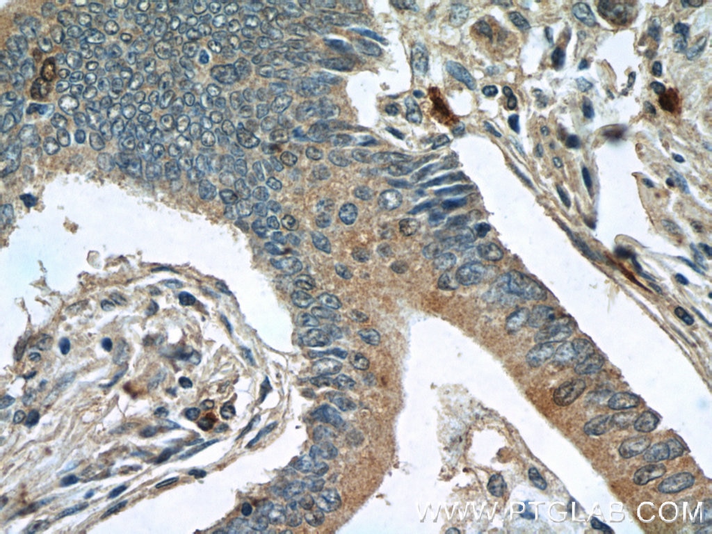 Immunohistochemistry (IHC) staining of human stomach cancer tissue using Paxillin Polyclonal antibody (22172-1-AP)