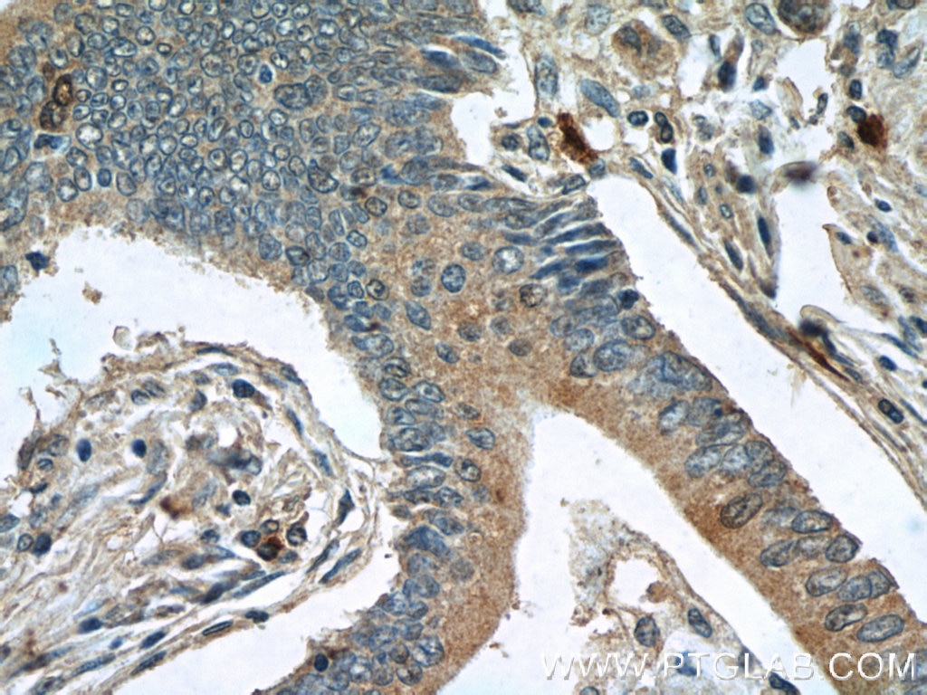 IHC staining of human stomach cancer using 22172-1-AP