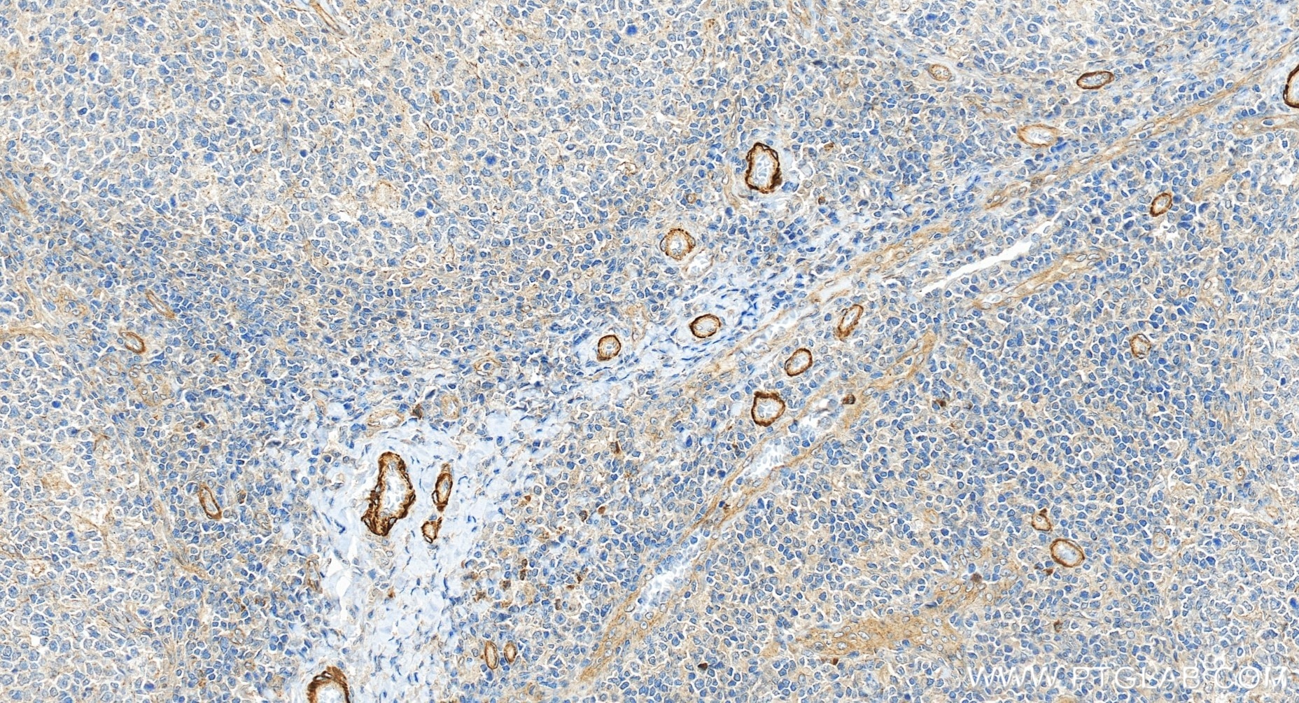 Immunohistochemistry (IHC) staining of human tonsillitis tissue using Pentraxin 3 Recombinant monoclonal antibody (84096-3-RR)