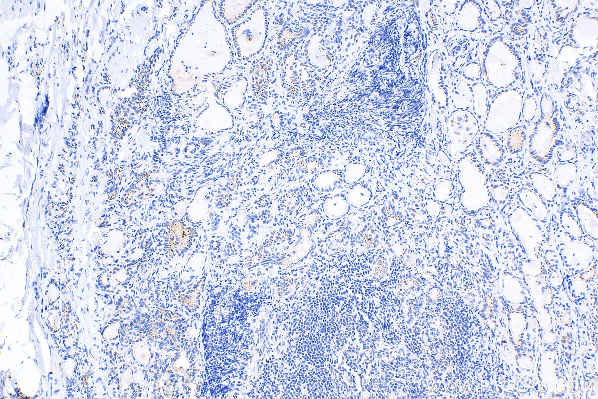 Immunohistochemistry (IHC) staining of human thyroid cancer tissue using Pericentrin Polyclonal antibody (27084-1-AP)