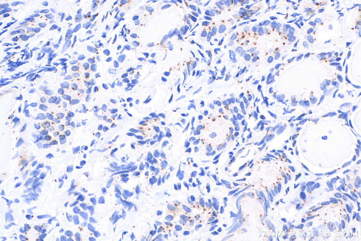 Immunohistochemistry (IHC) staining of human thyroid cancer tissue using Pericentrin Polyclonal antibody (27084-1-AP)