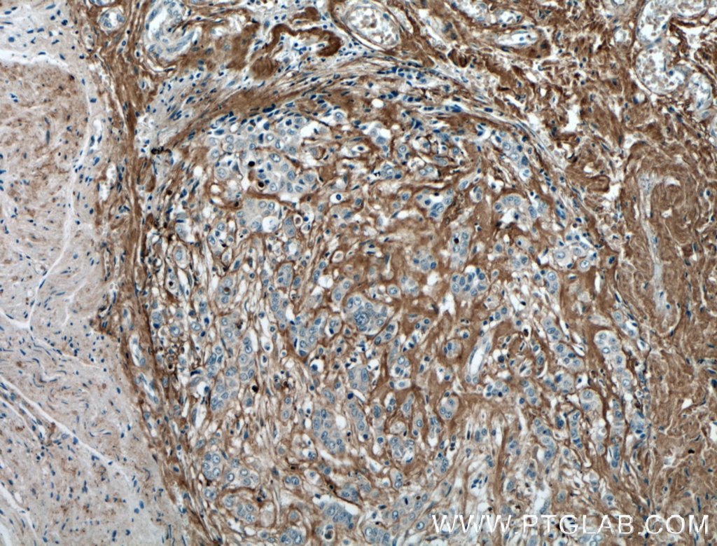 Immunohistochemistry (IHC) staining of human colon cancer tissue using Periostin Polyclonal antibody (27794-1-AP)