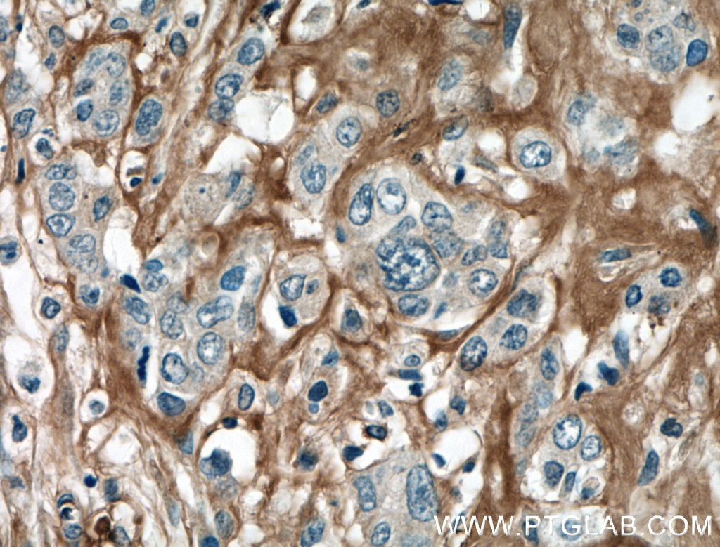 Immunohistochemistry (IHC) staining of human colon cancer tissue using Periostin Polyclonal antibody (27794-1-AP)