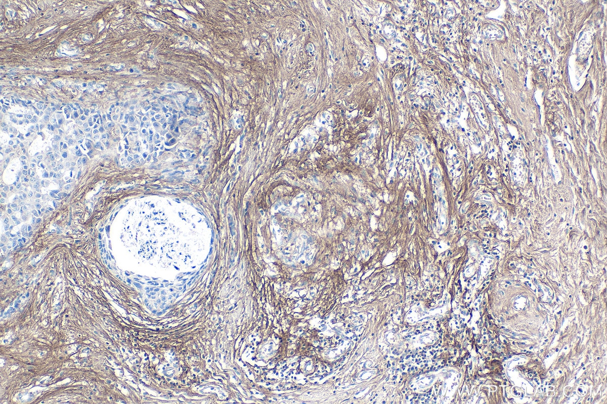 Immunohistochemistry (IHC) staining of human breast cancer tissue using Periostin Polyclonal antibody (27794-1-AP)