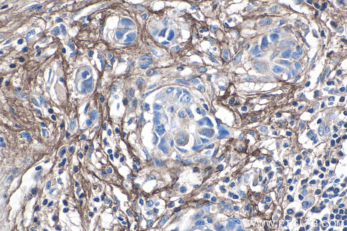 Immunohistochemistry (IHC) staining of human breast cancer tissue using Periostin Polyclonal antibody (27794-1-AP)