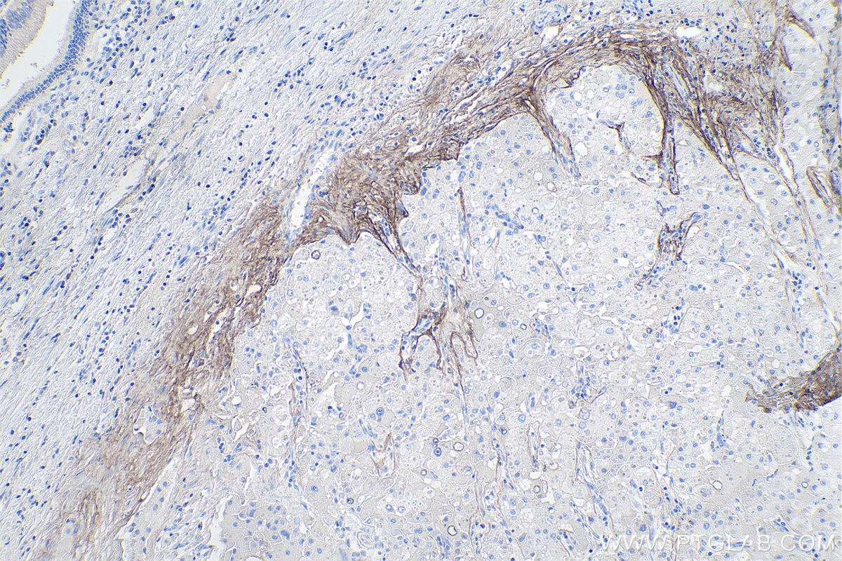 IHC staining of human liver cancer using 27794-1-AP