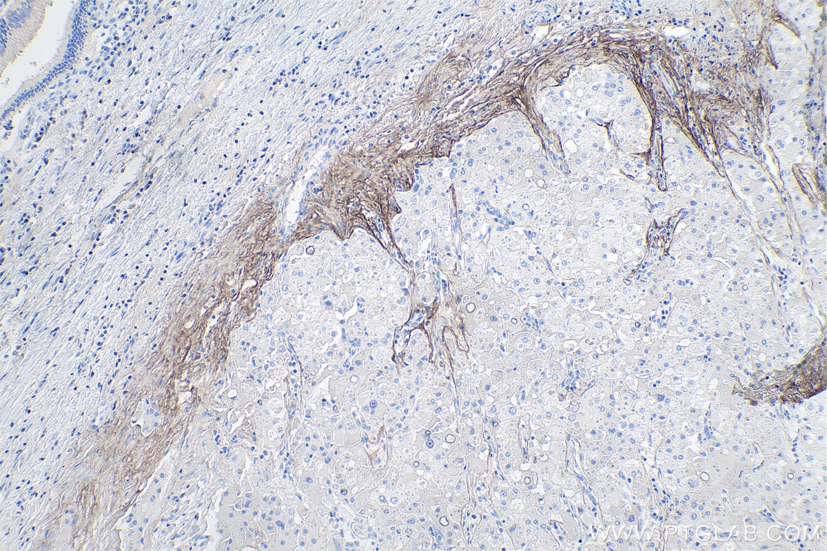 Immunohistochemistry (IHC) staining of human liver cancer tissue using Periostin Polyclonal antibody (27794-1-AP)