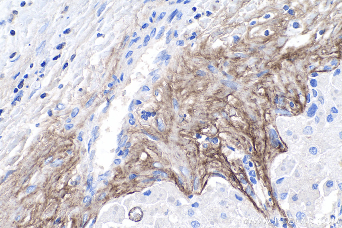 Immunohistochemistry (IHC) staining of human liver cancer tissue using Periostin Polyclonal antibody (27794-1-AP)