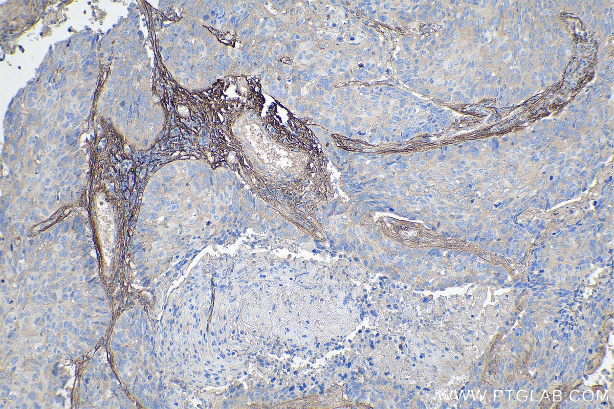 IHC staining of human lung cancer using 27794-1-AP