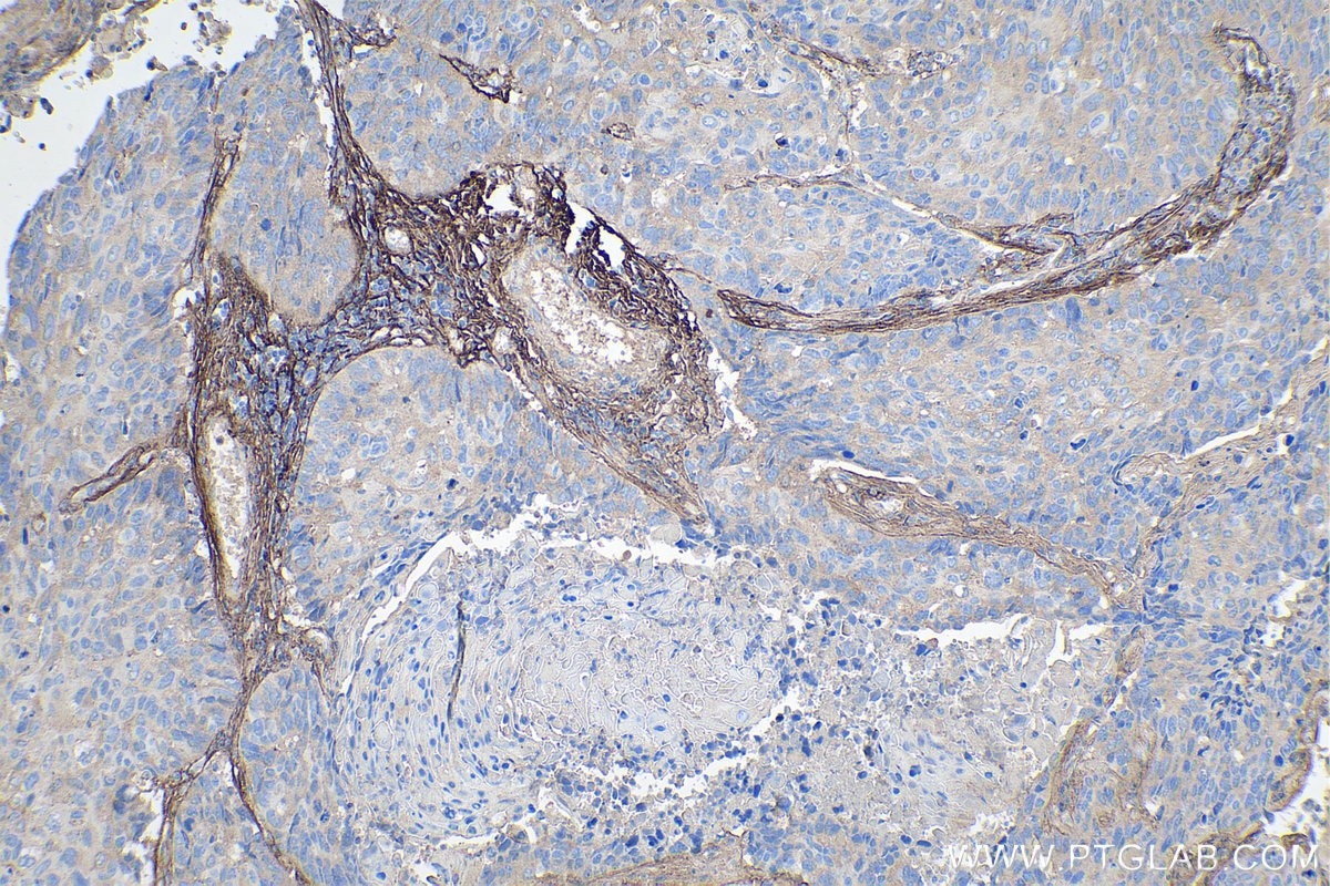 Immunohistochemistry (IHC) staining of human lung cancer tissue using Periostin Polyclonal antibody (27794-1-AP)